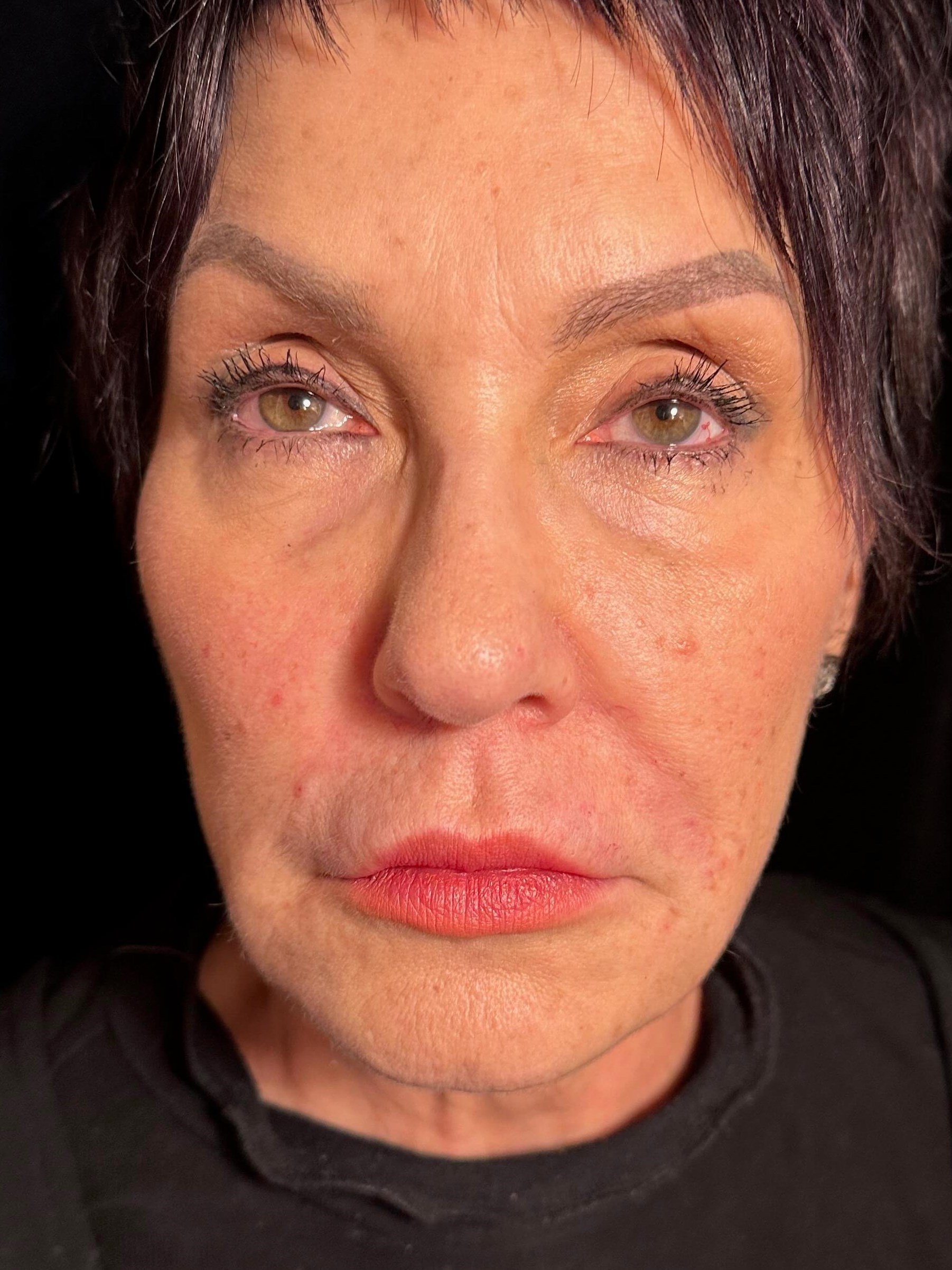 After Image: Dermal Fillers - front