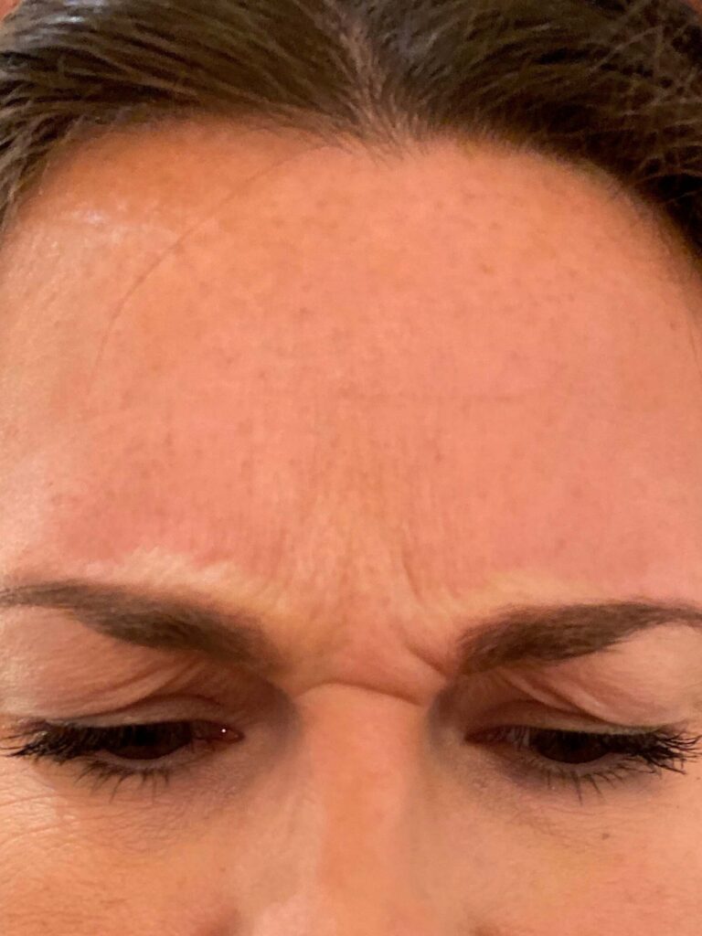 Before Image: BOTOX® Cosmetic - front
