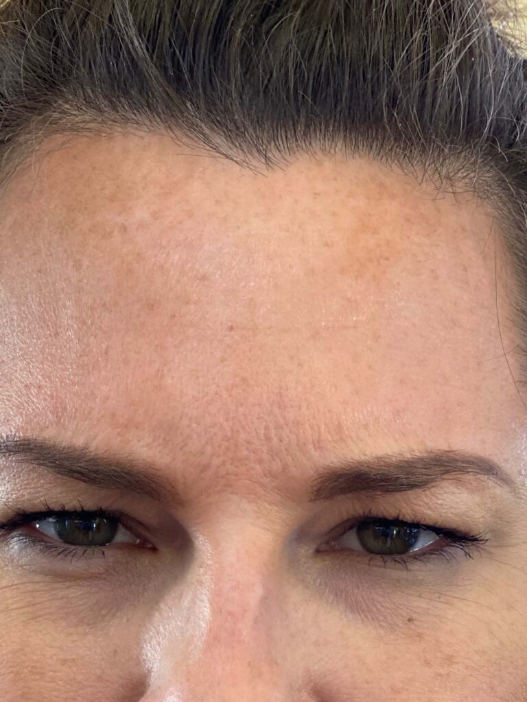 After Image: BOTOX® Cosmetic - front