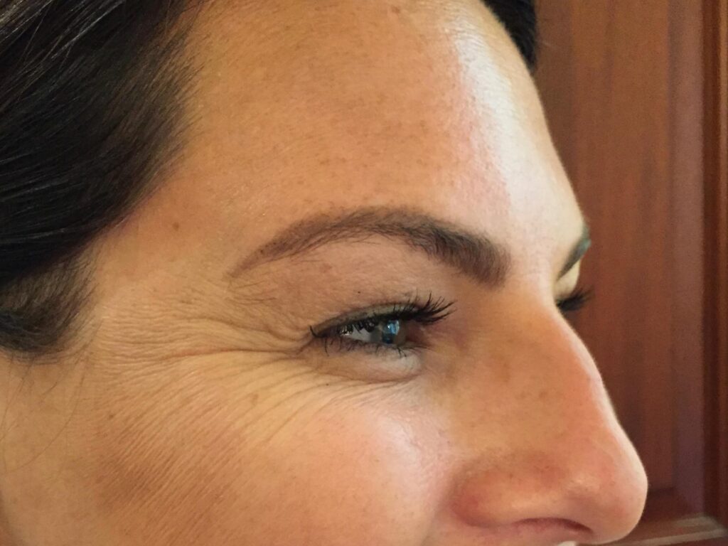 Before Image: BOTOX® Cosmetic - right-front-oblique