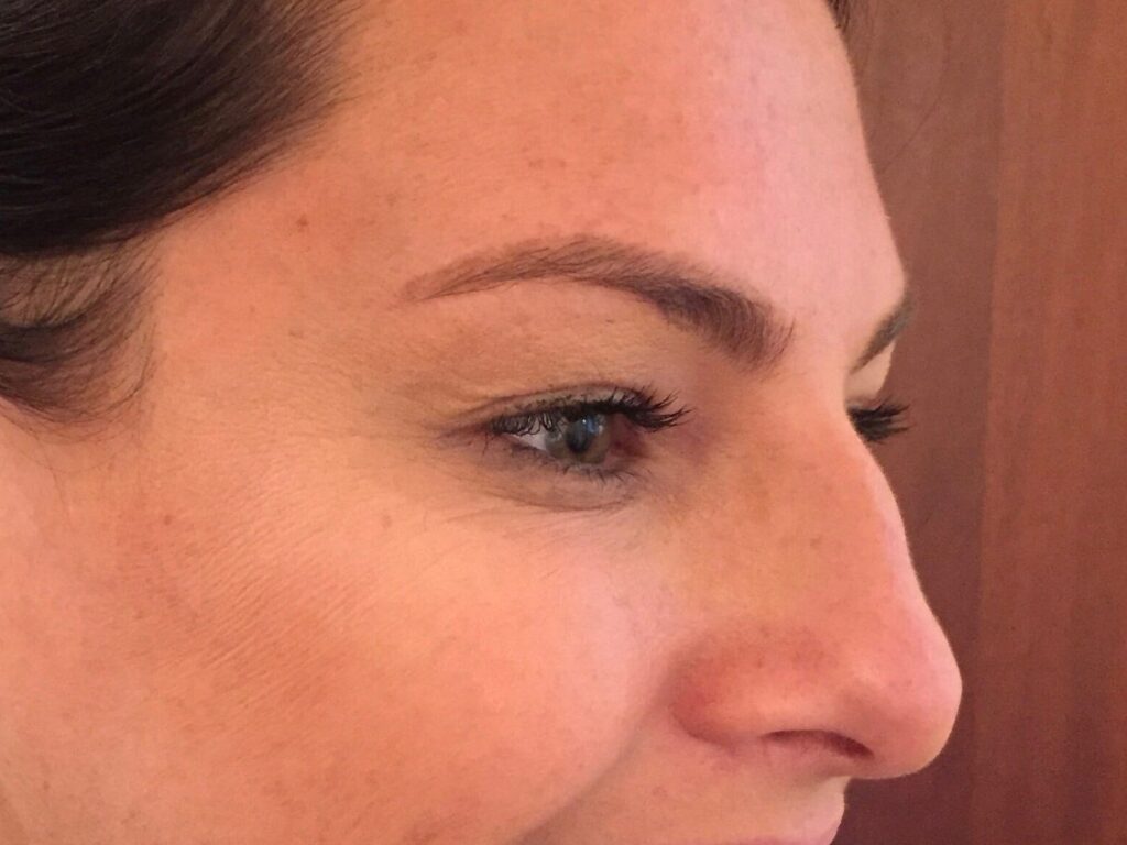 After Image: BOTOX® Cosmetic - right-front-oblique