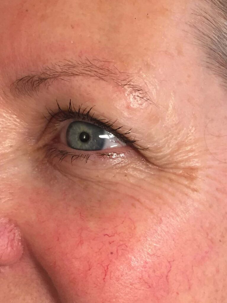 Before Image: Dysport® - left-front-oblique