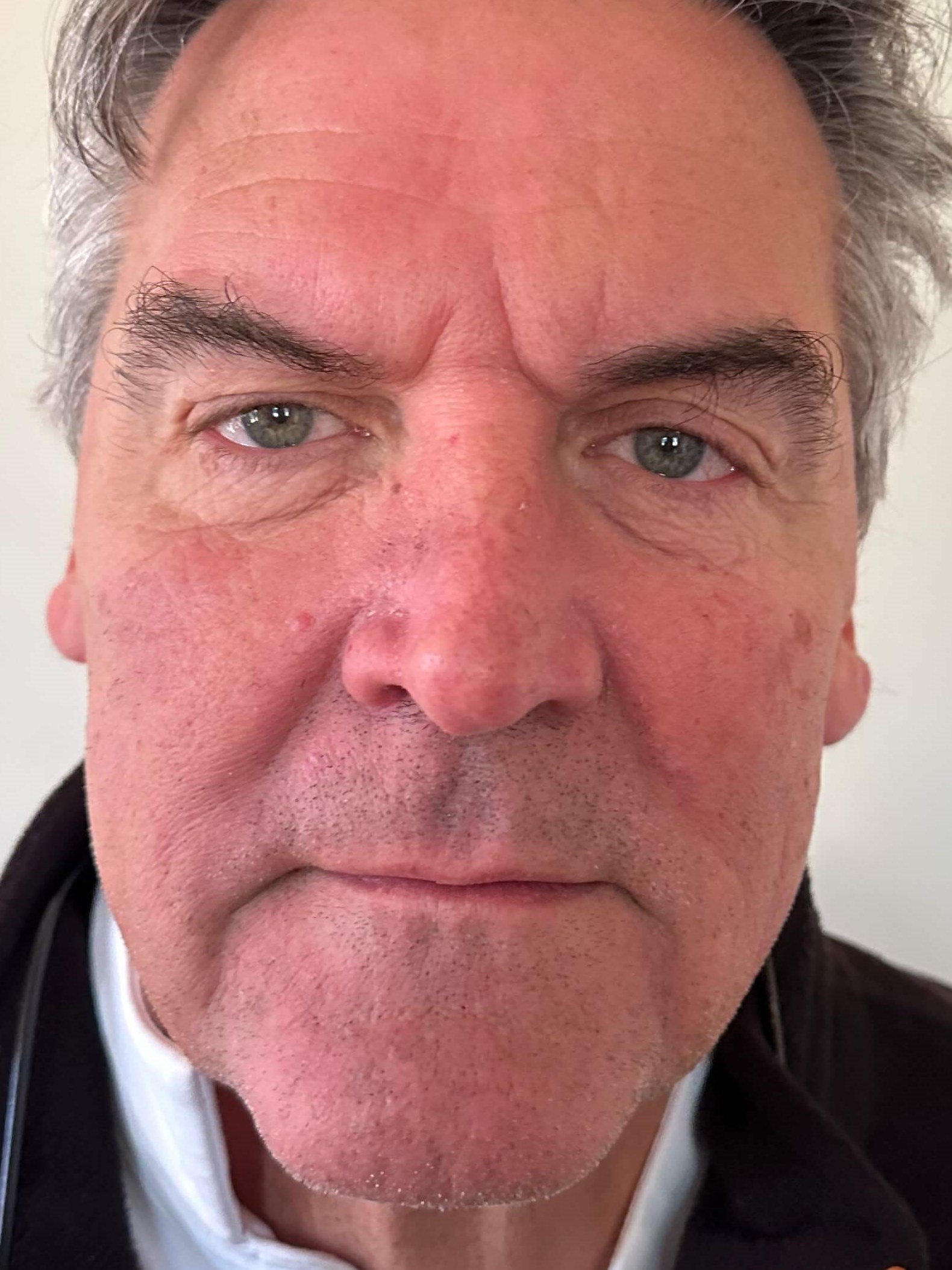 Before Image: Dermal Fillers - front