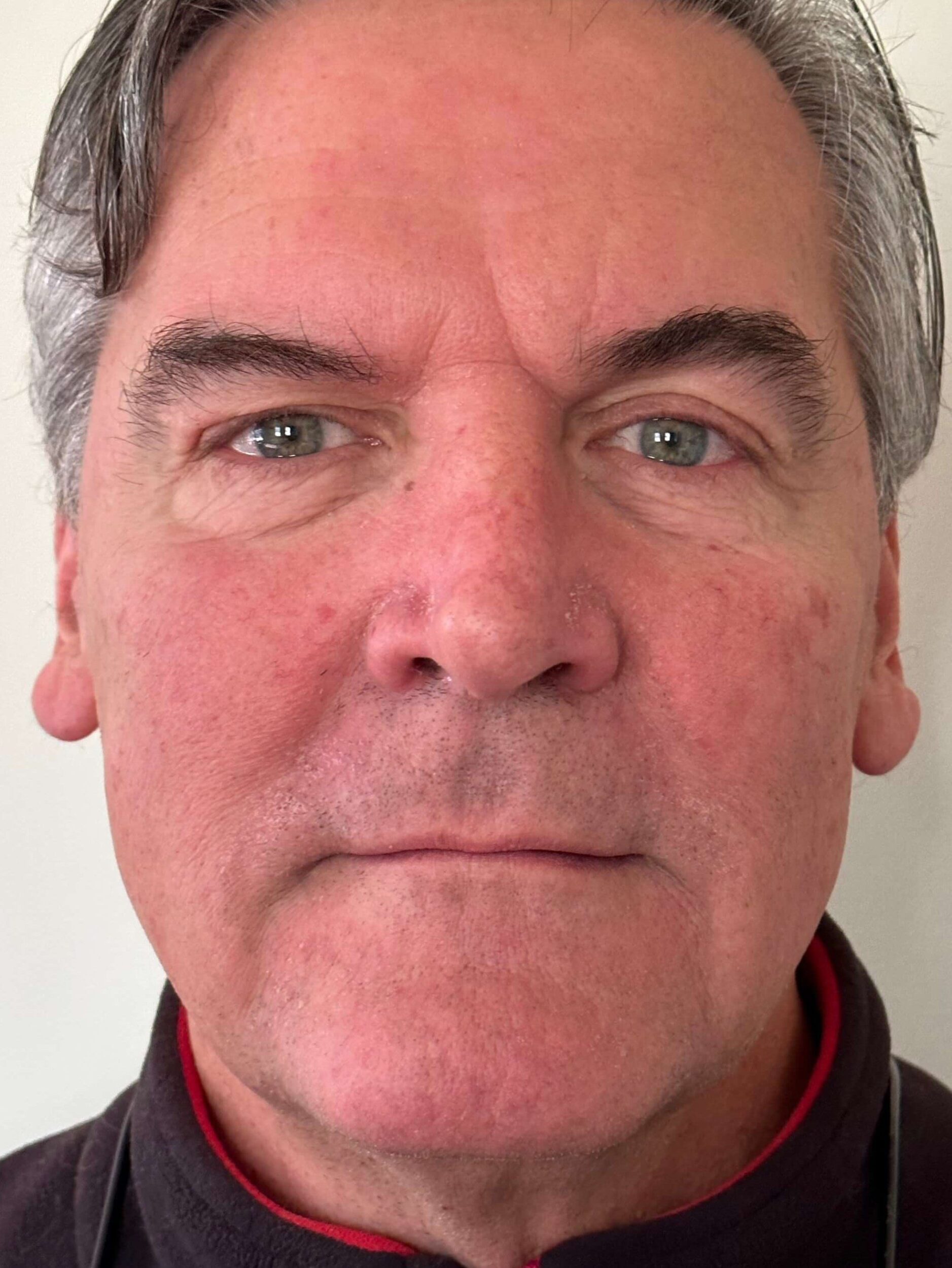 After Image: Dermal Fillers - front