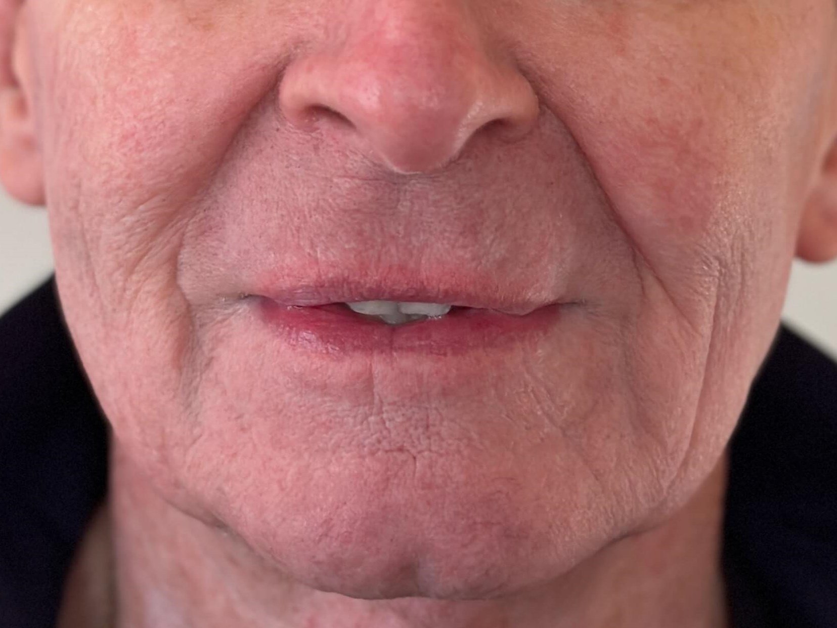 Before Image: Juvéderm® - front