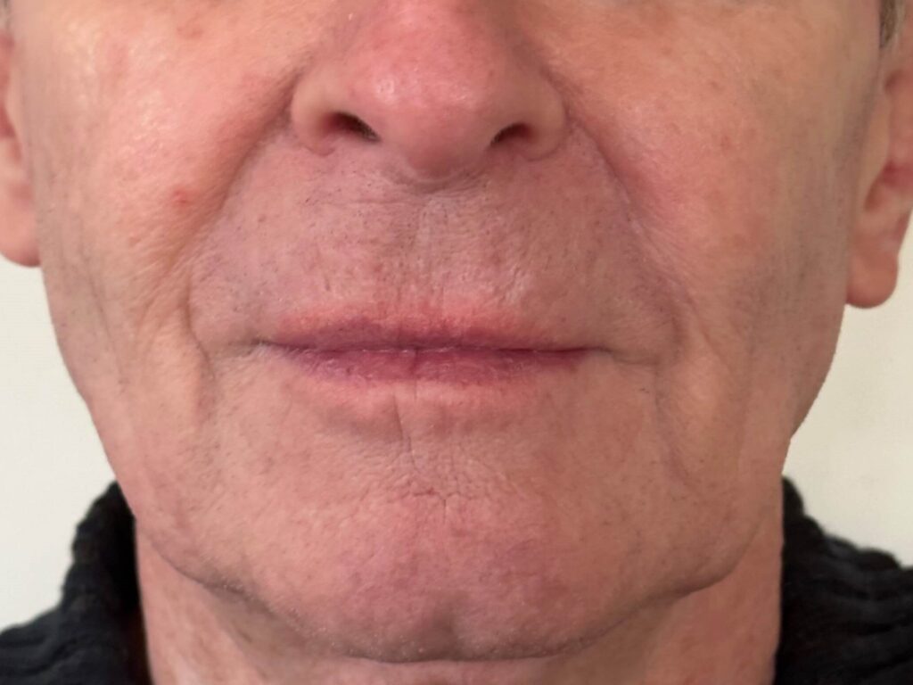 After Image: Juvéderm® - front