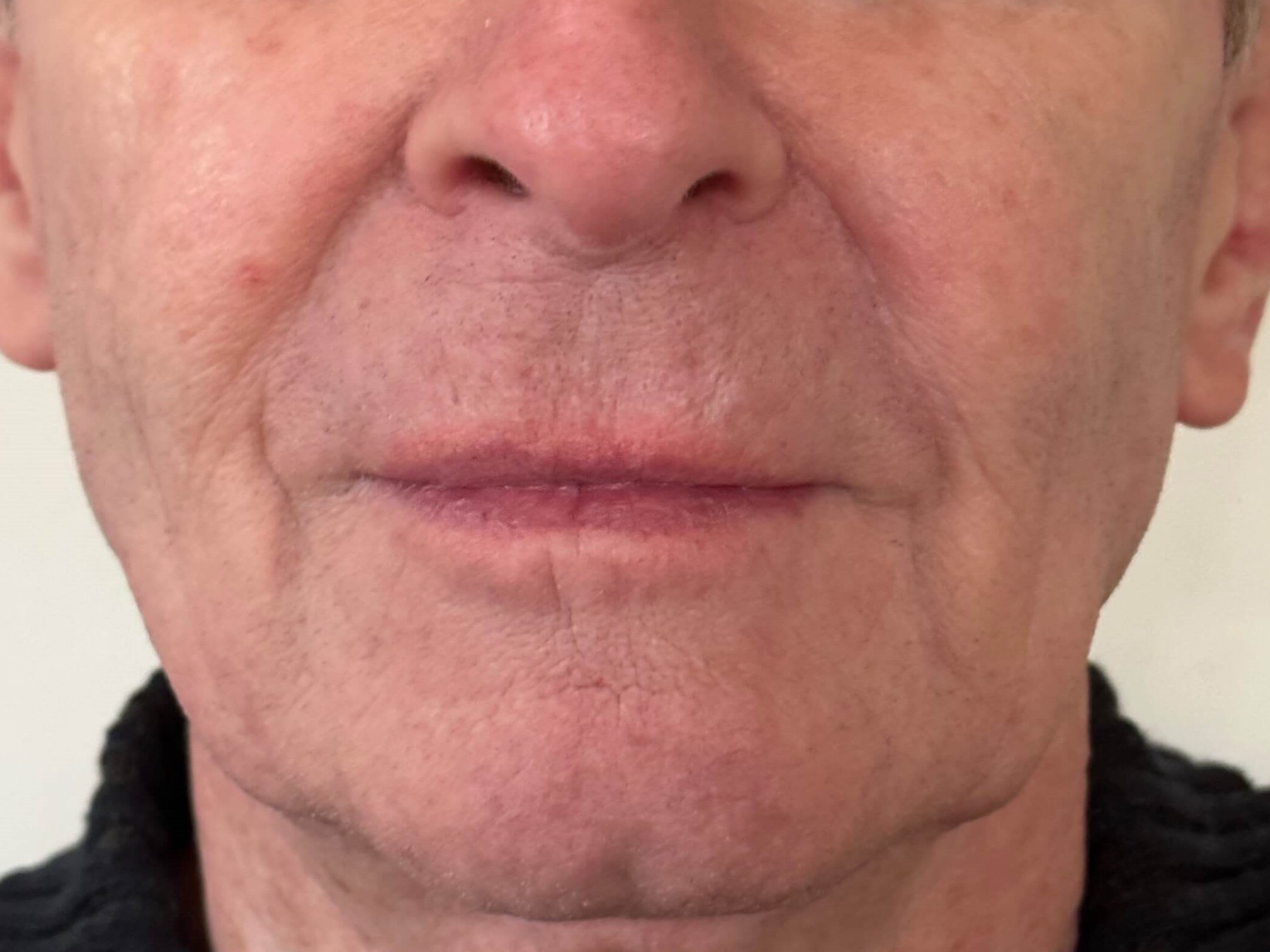 After Image: Juvéderm® - front