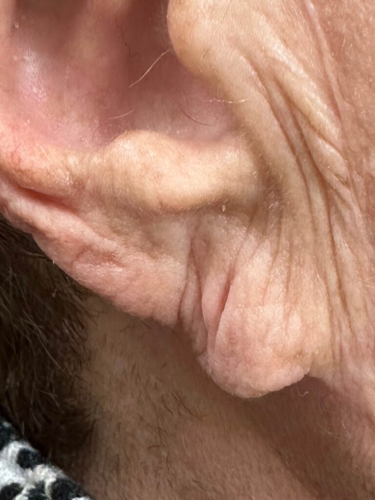 Before Image: Dermal Fillers - front