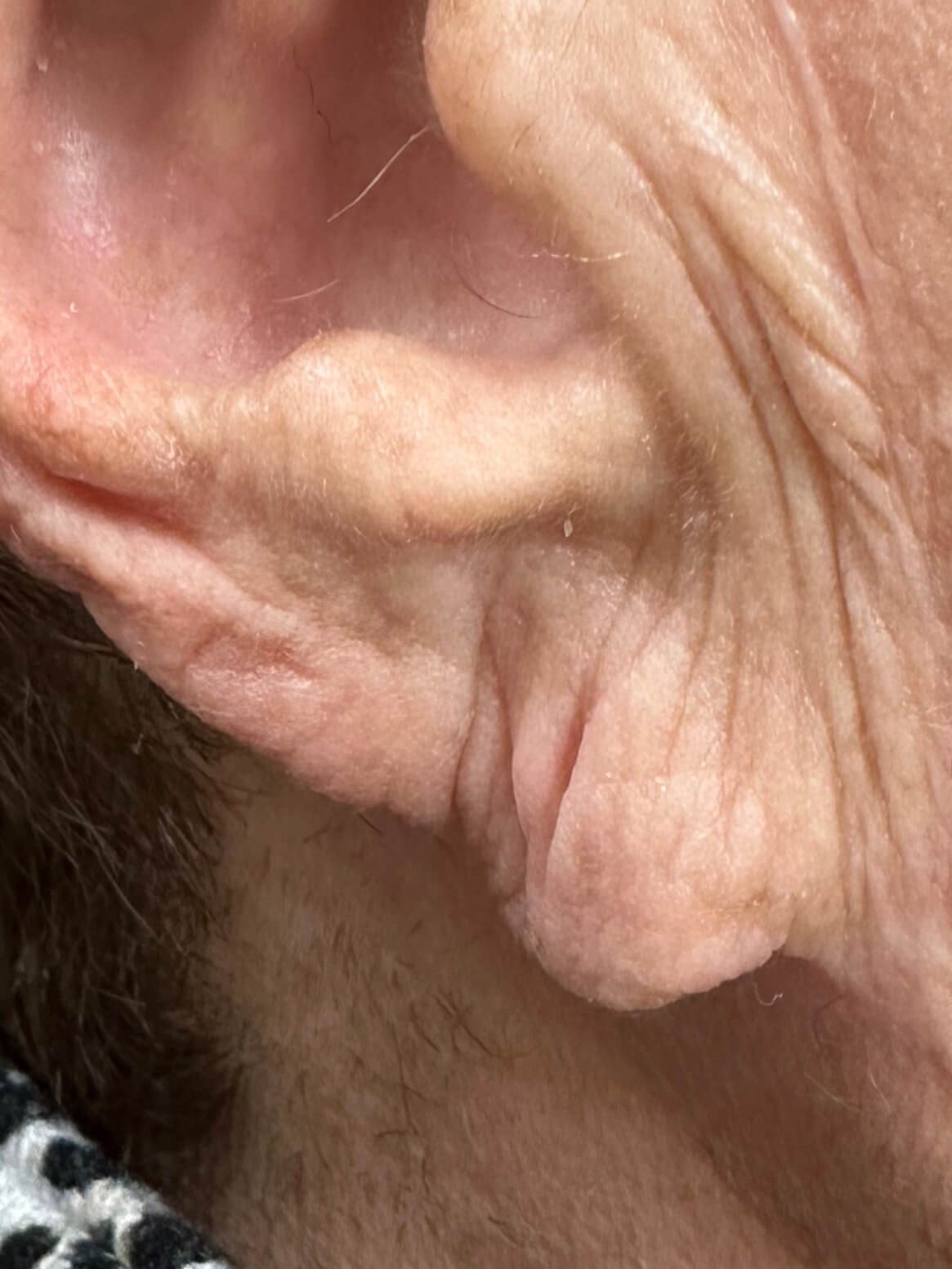 Before Image: Dermal Fillers - front
