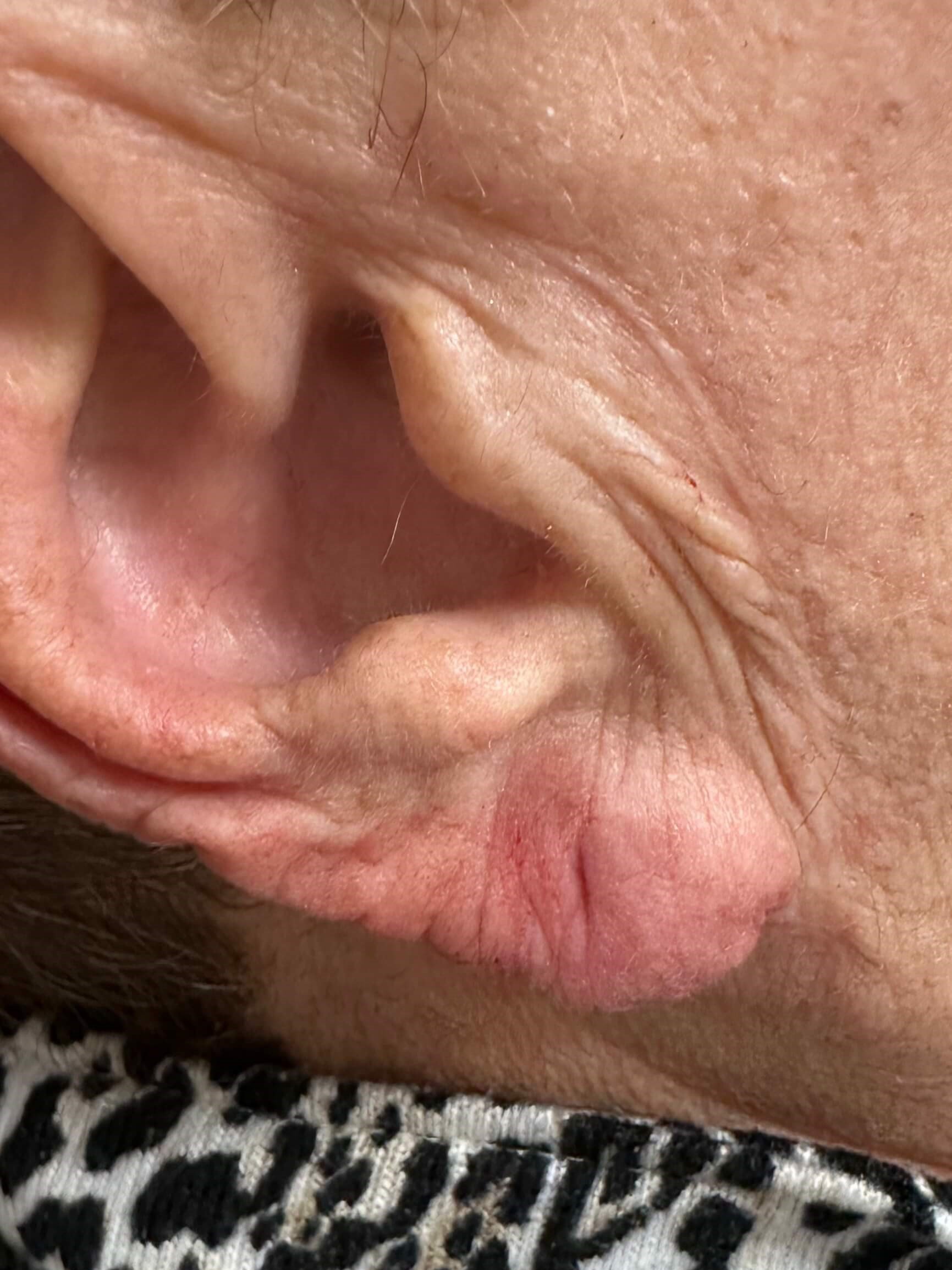 After Image: Dermal Fillers - front