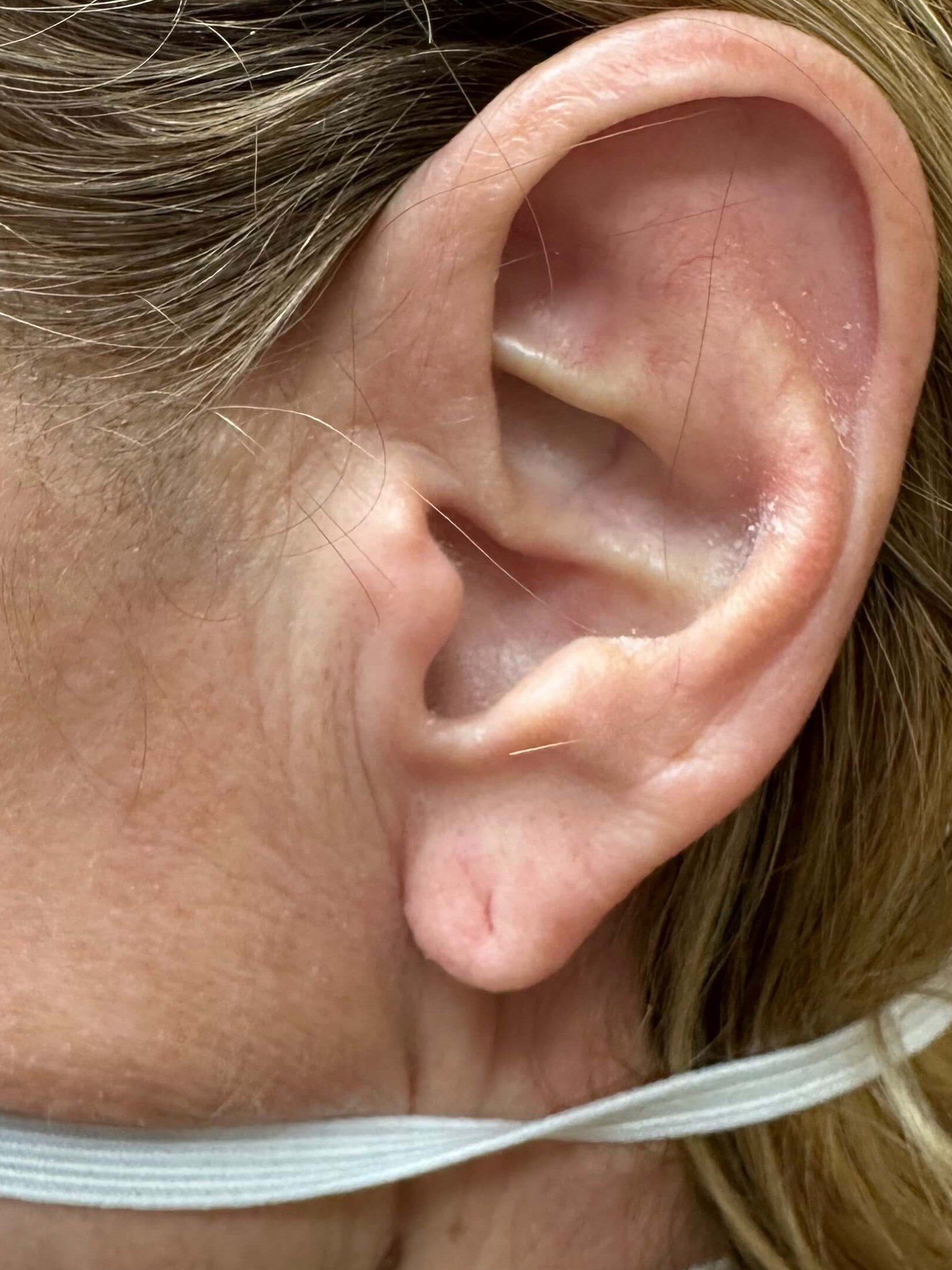 Before Image: Dermal Fillers - left-side