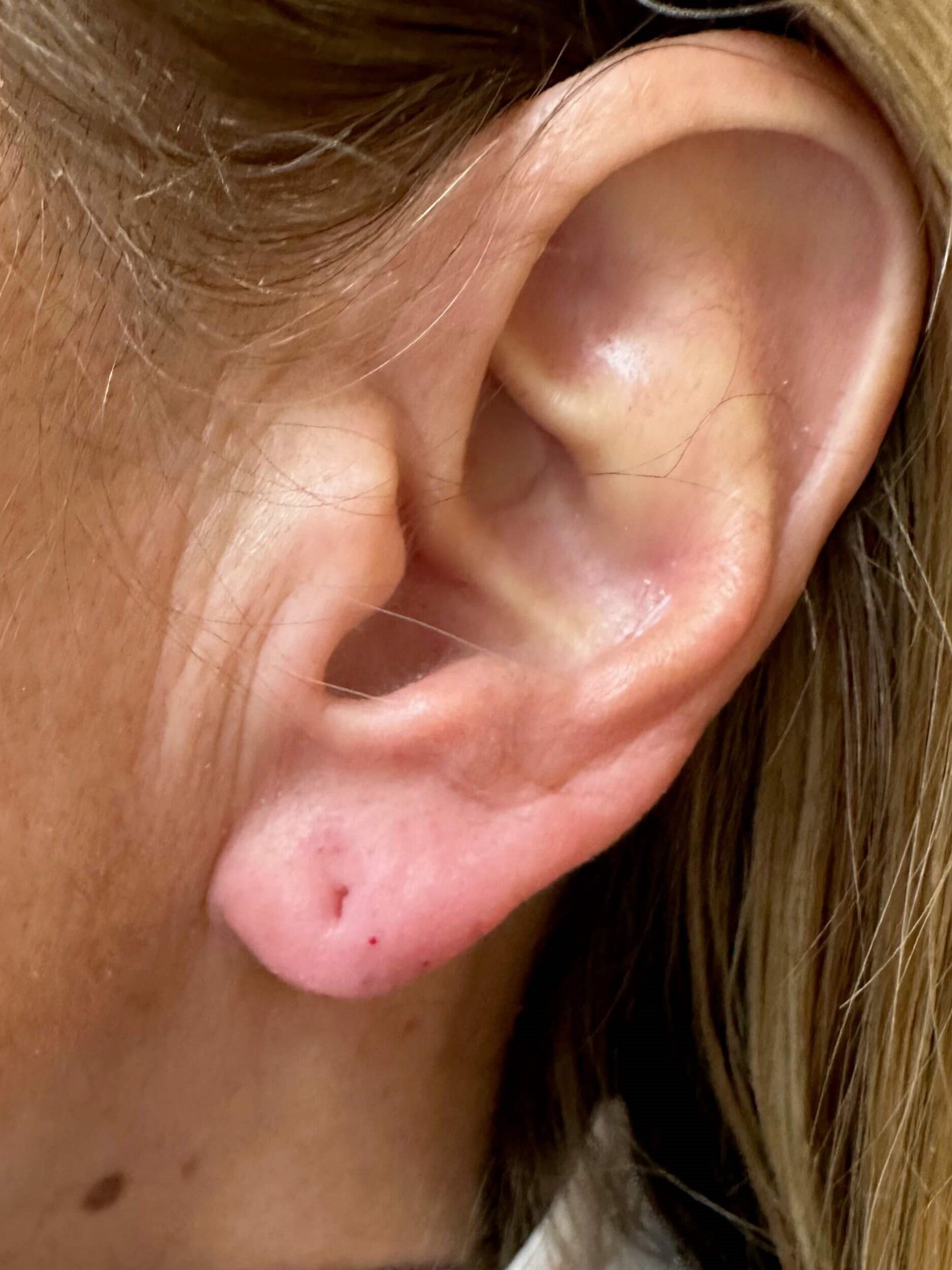 After Image: Dermal Fillers - left-side