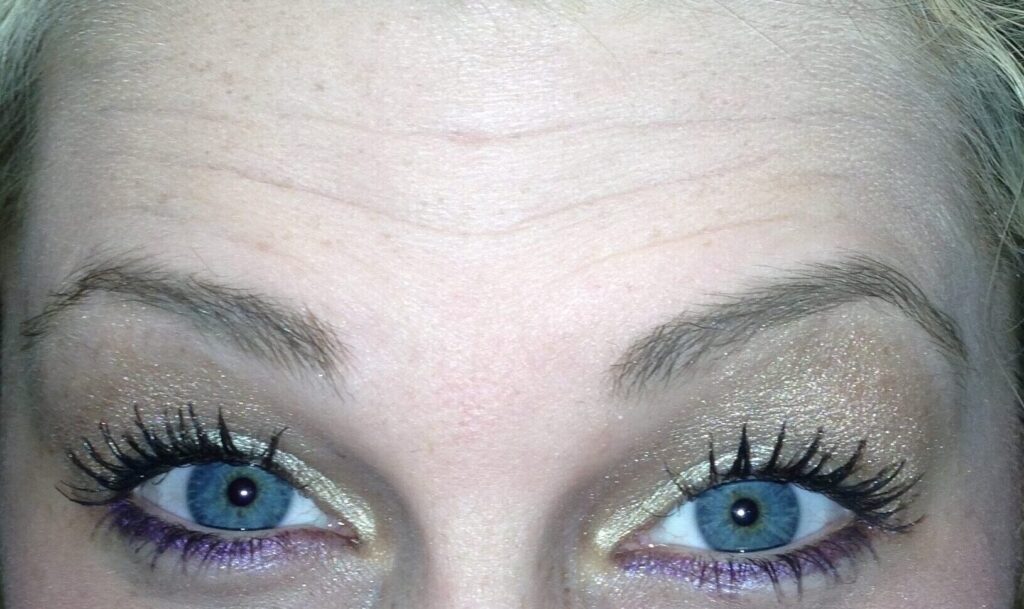 Before Image: BOTOX® Cosmetic - front