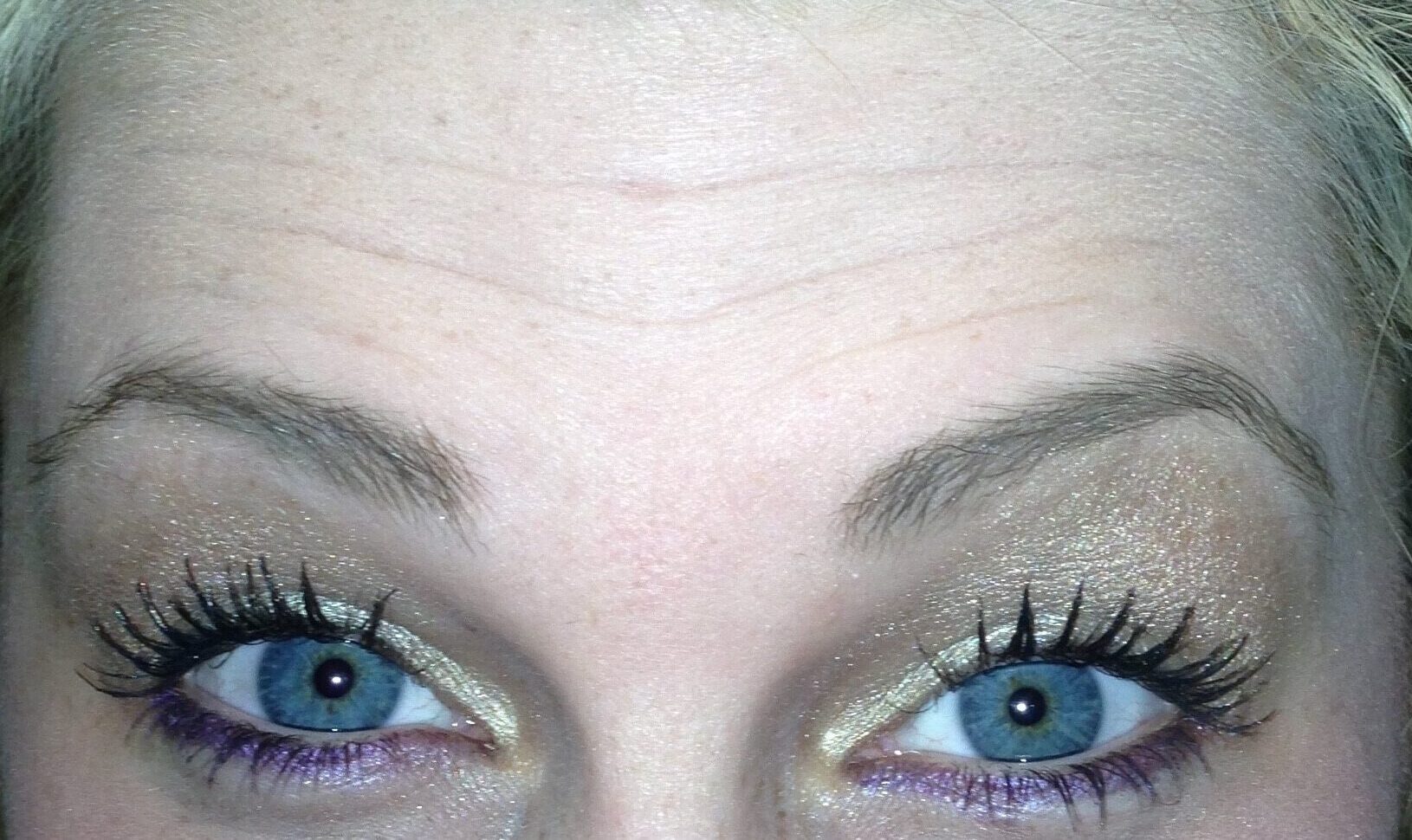 Before Image: BOTOX® Cosmetic - front