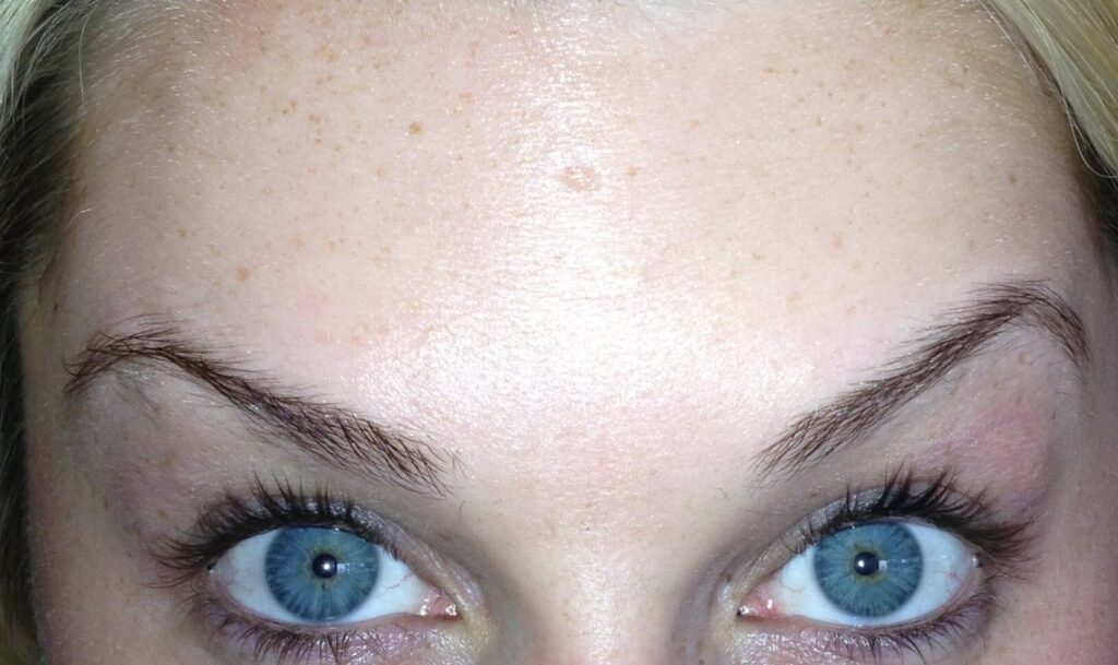 After Image: BOTOX® Cosmetic - front