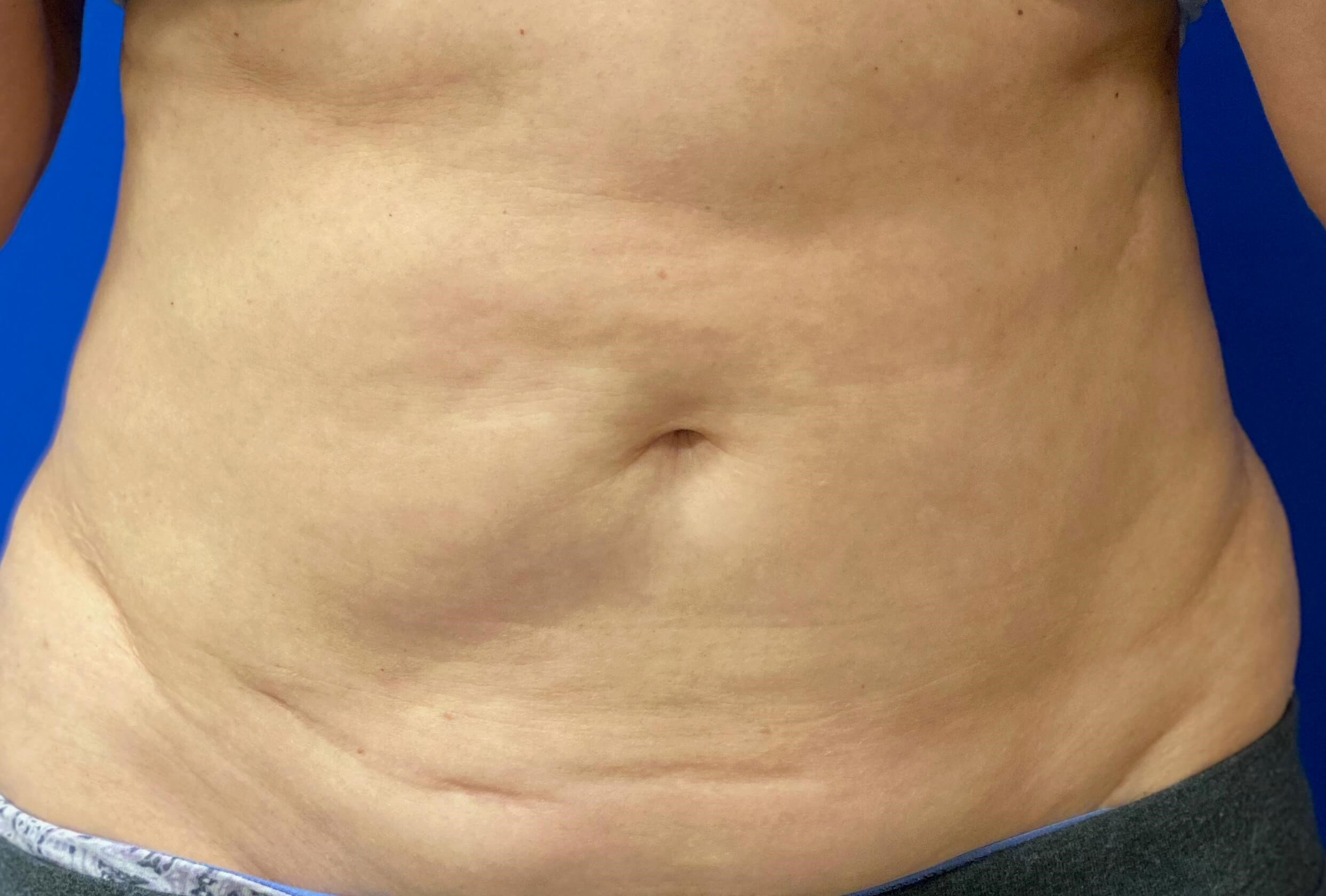 Before Image: truSculpt® iD - front