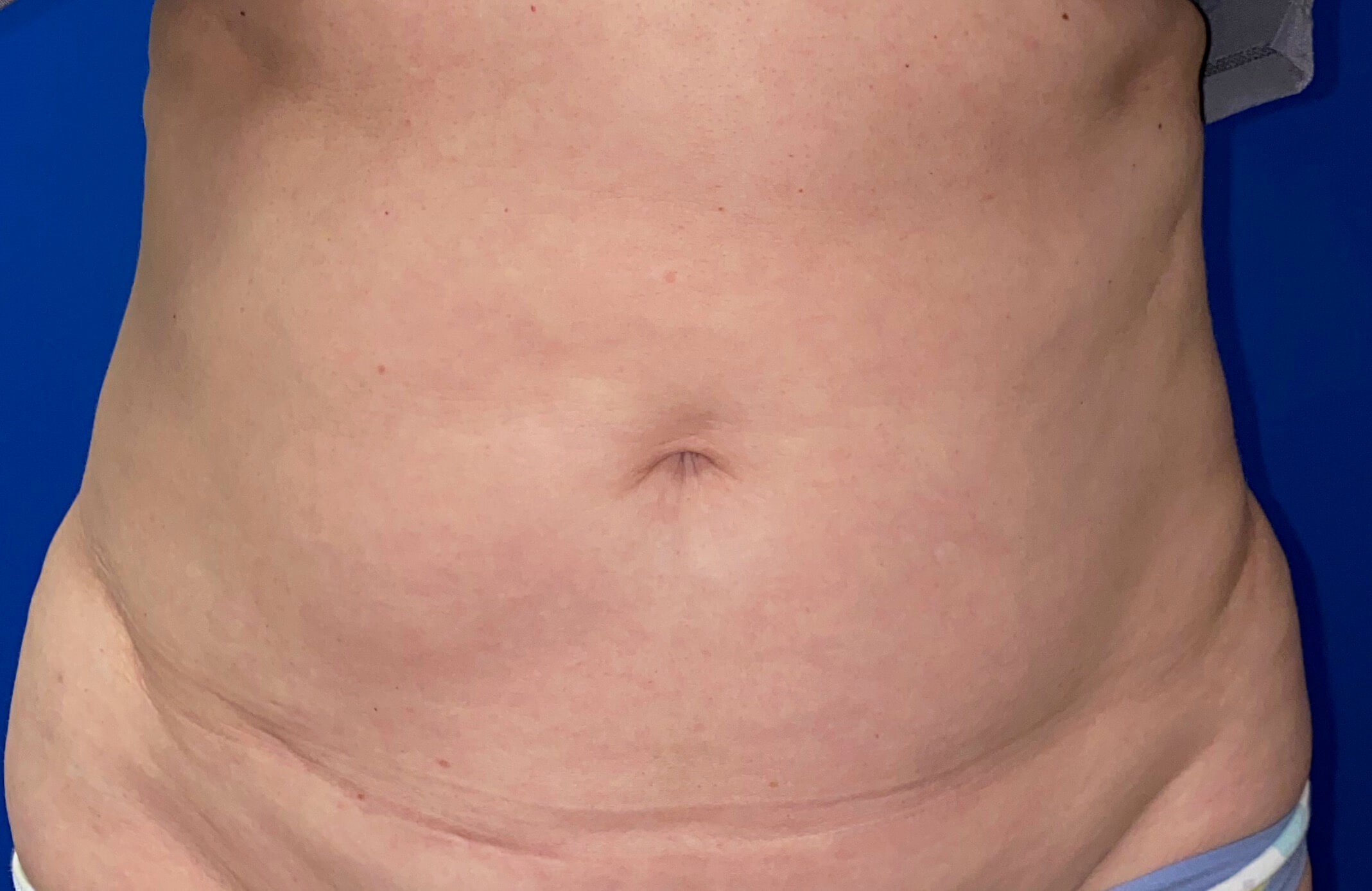 After Image: truSculpt® iD - front