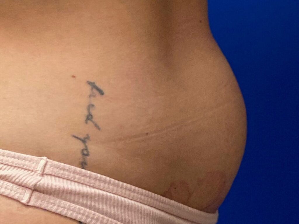 Before Image: truSculpt® iD - right-side