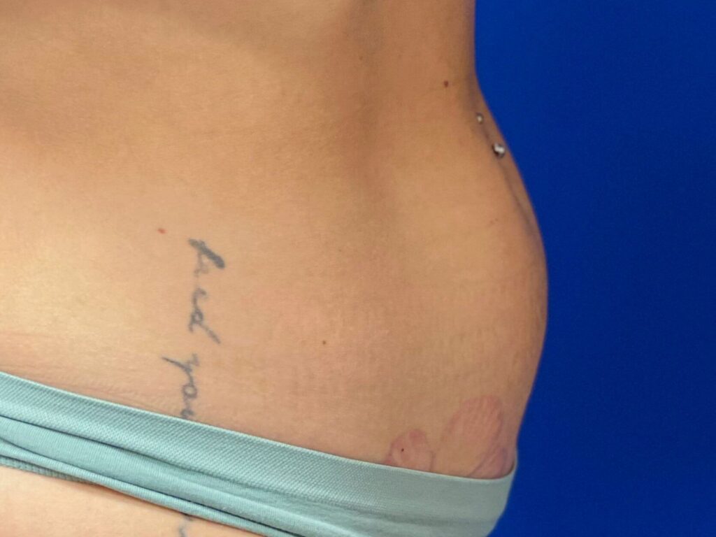 After Image: truSculpt® iD - right-side
