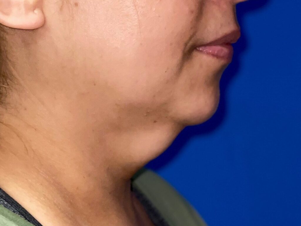 Before Image: truSculpt® iD - right-side
