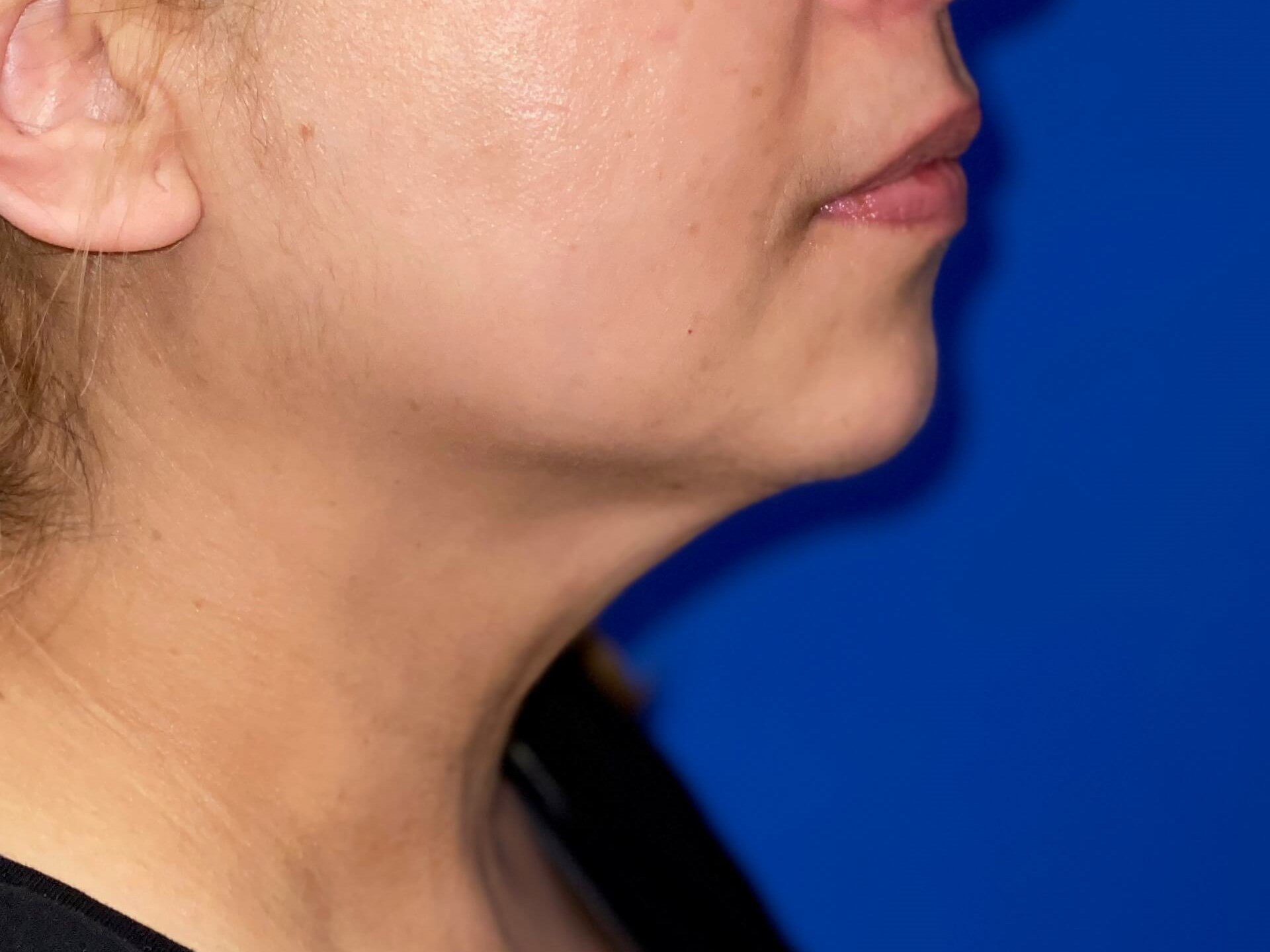 After Image: truSculpt® iD - right-side