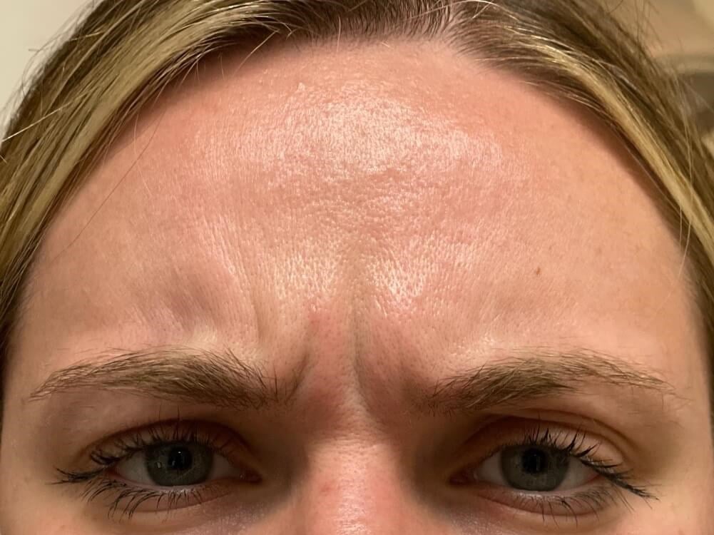 Before Image: BOTOX® Cosmetic - front