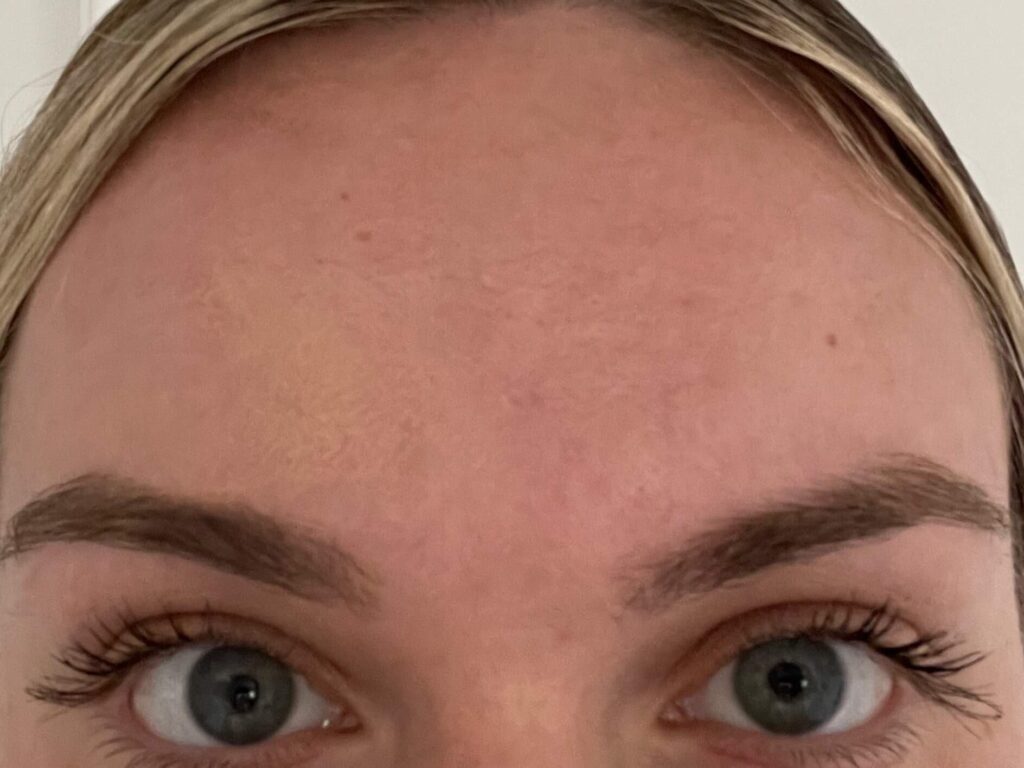 After Image: BOTOX® Cosmetic - front
