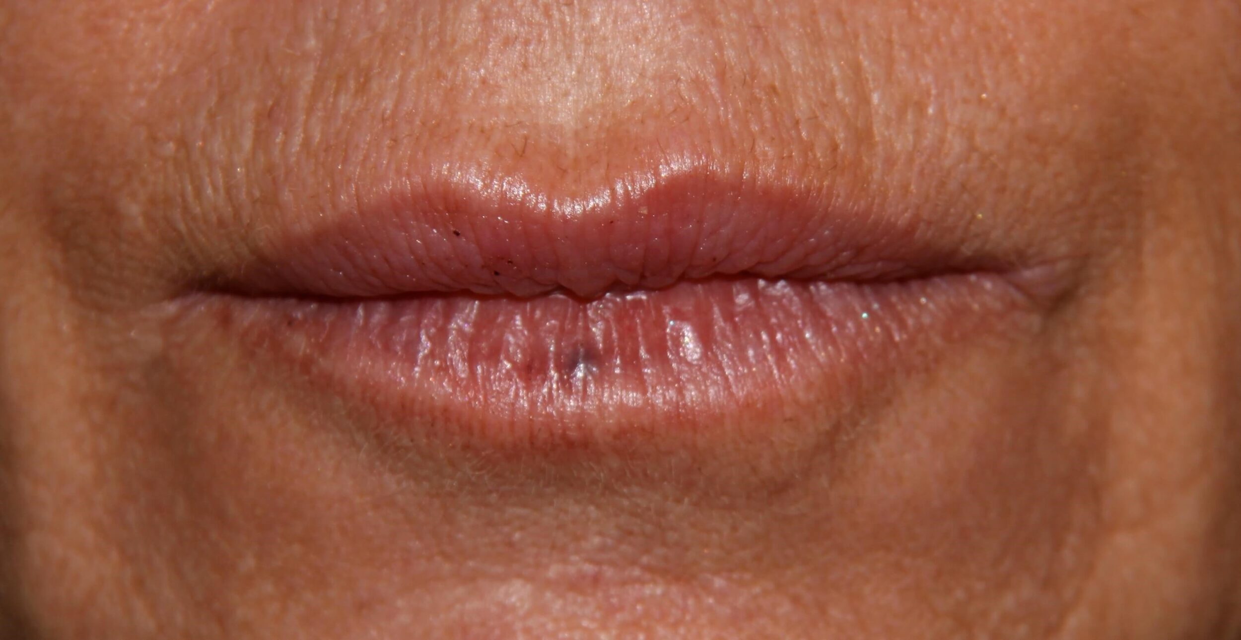 Before Image: Dermal Fillers - front