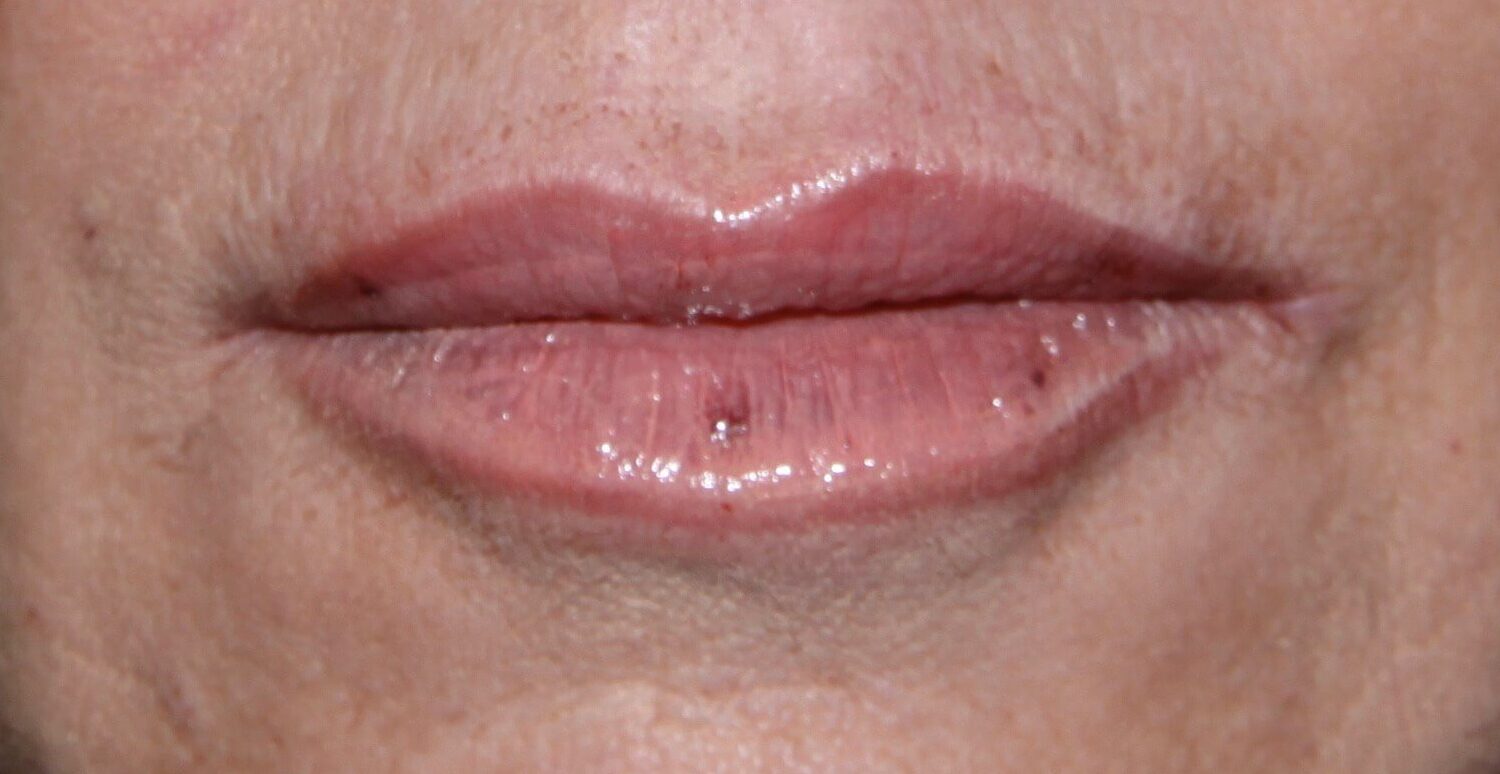 After Image: Dermal Fillers - front