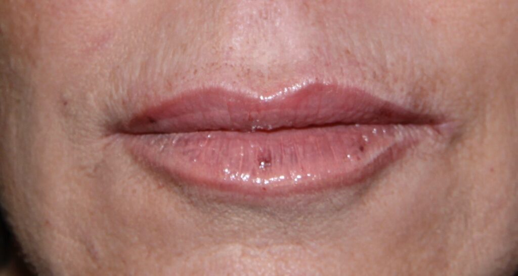 After Image: Juvéderm® - front