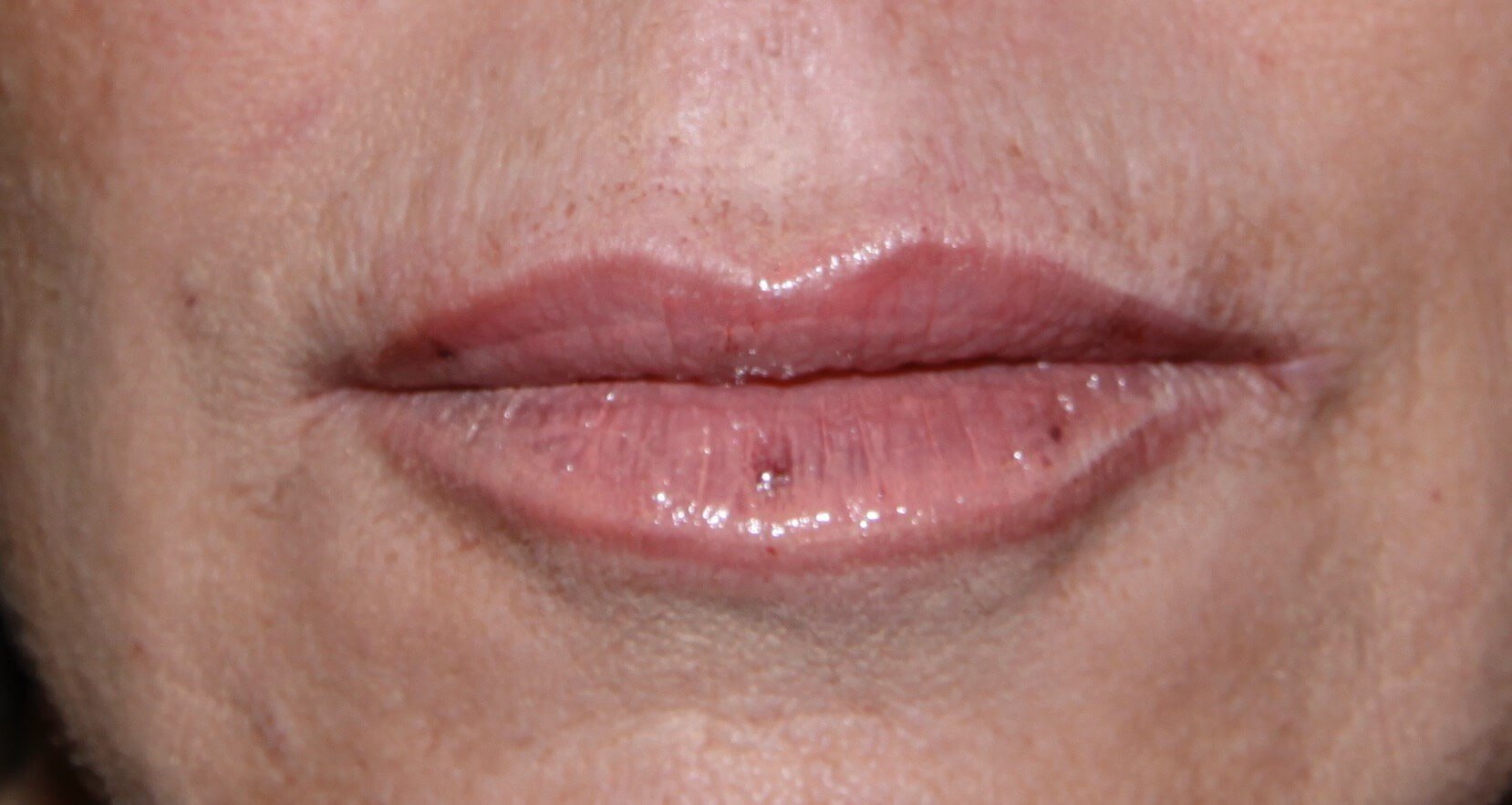 After Image: Juvéderm® - front