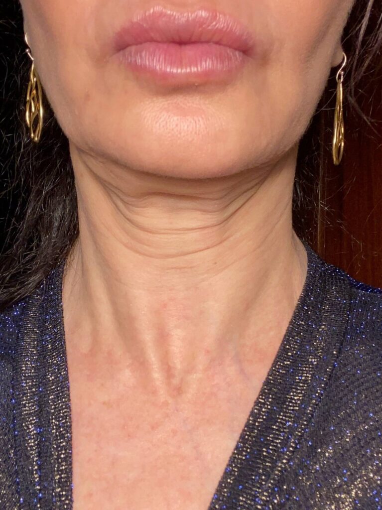 Before Image: BOTOX® Cosmetic - front