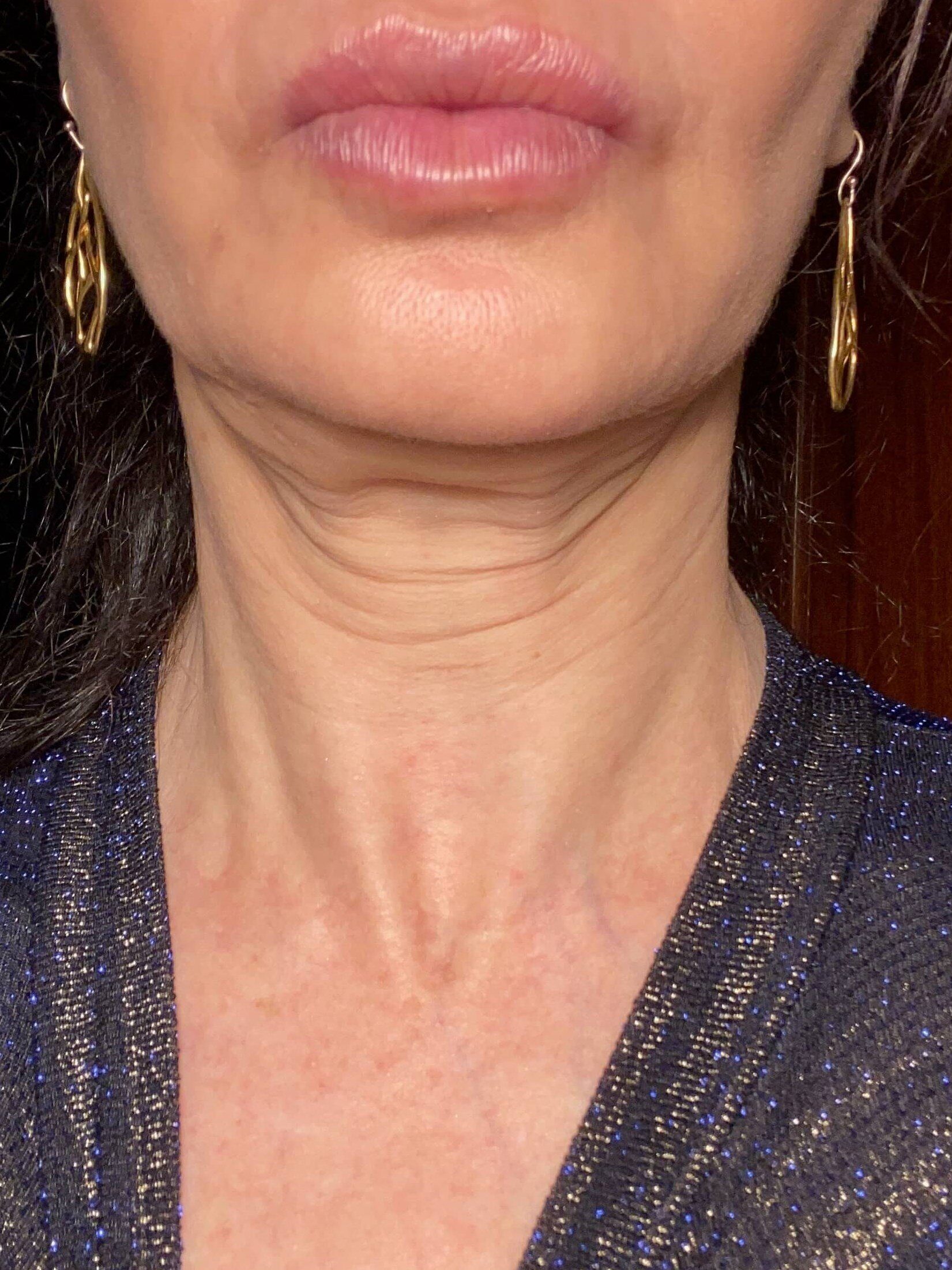 Before Image: BOTOX® Cosmetic - front