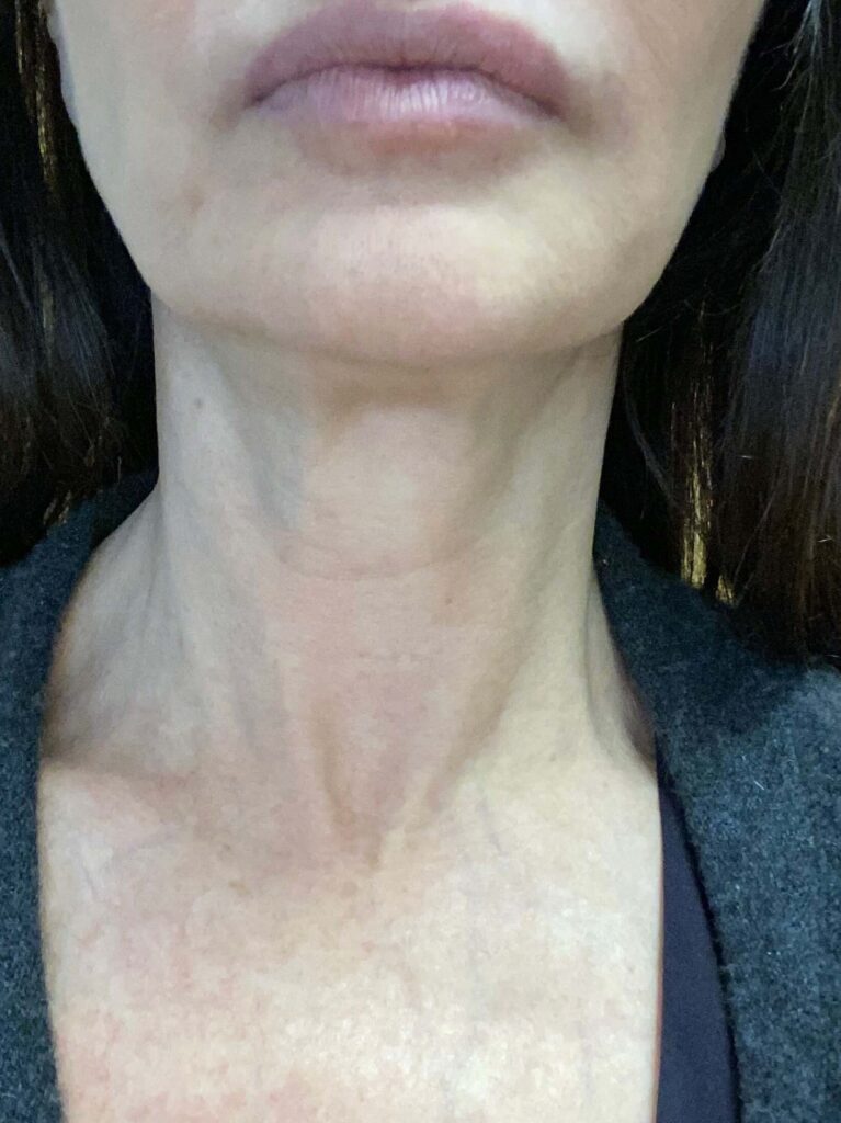 After Image: BOTOX® Cosmetic - front