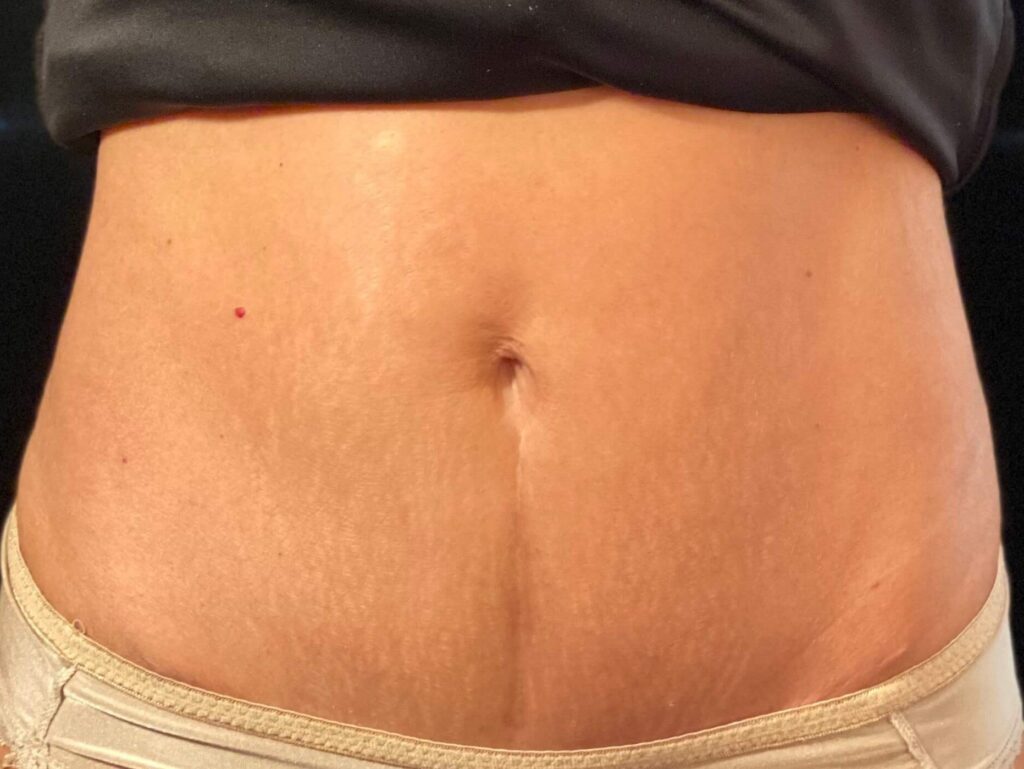 Before Image: truSculpt® iD - front