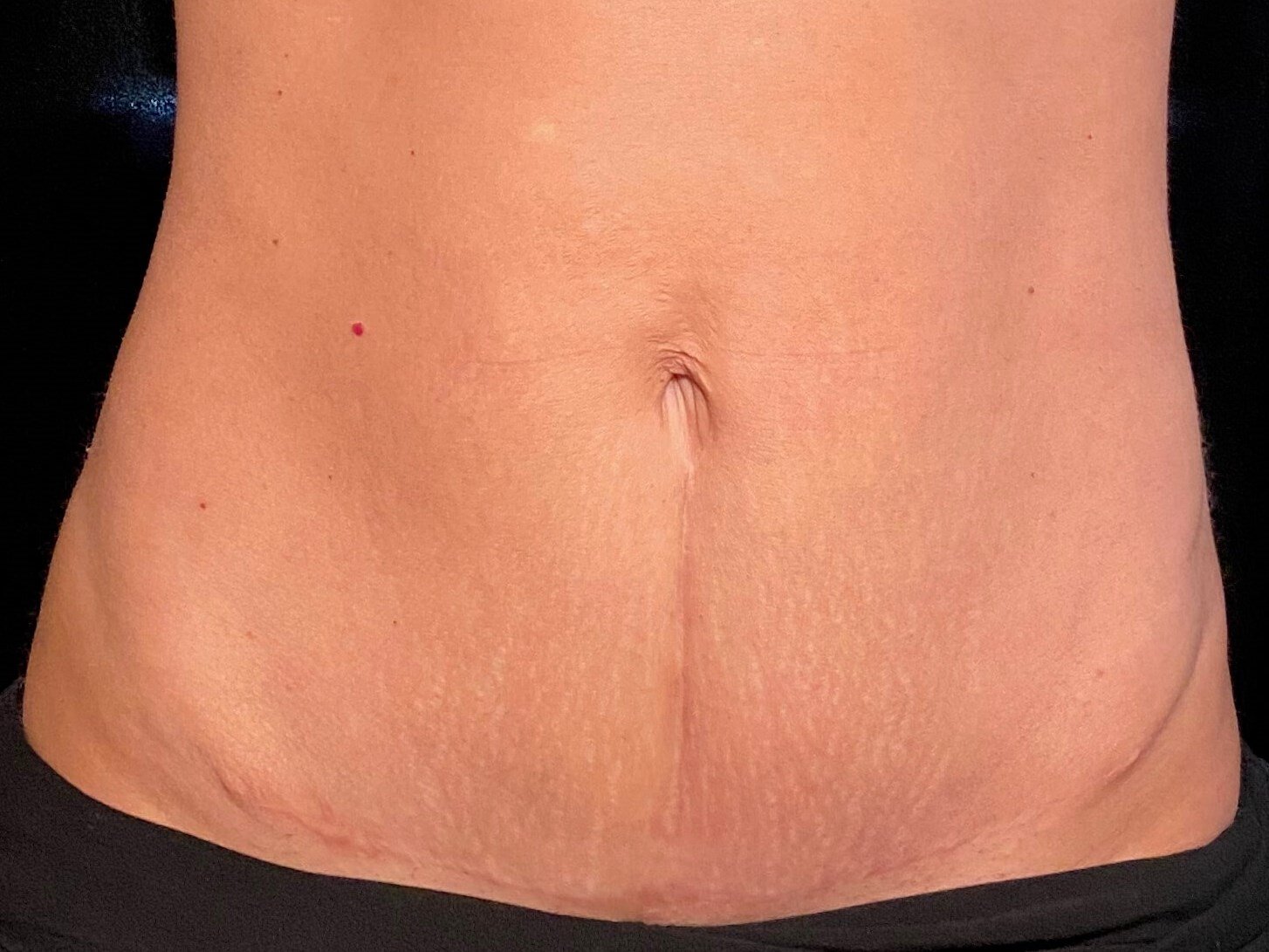 After Image: truSculpt® iD - front