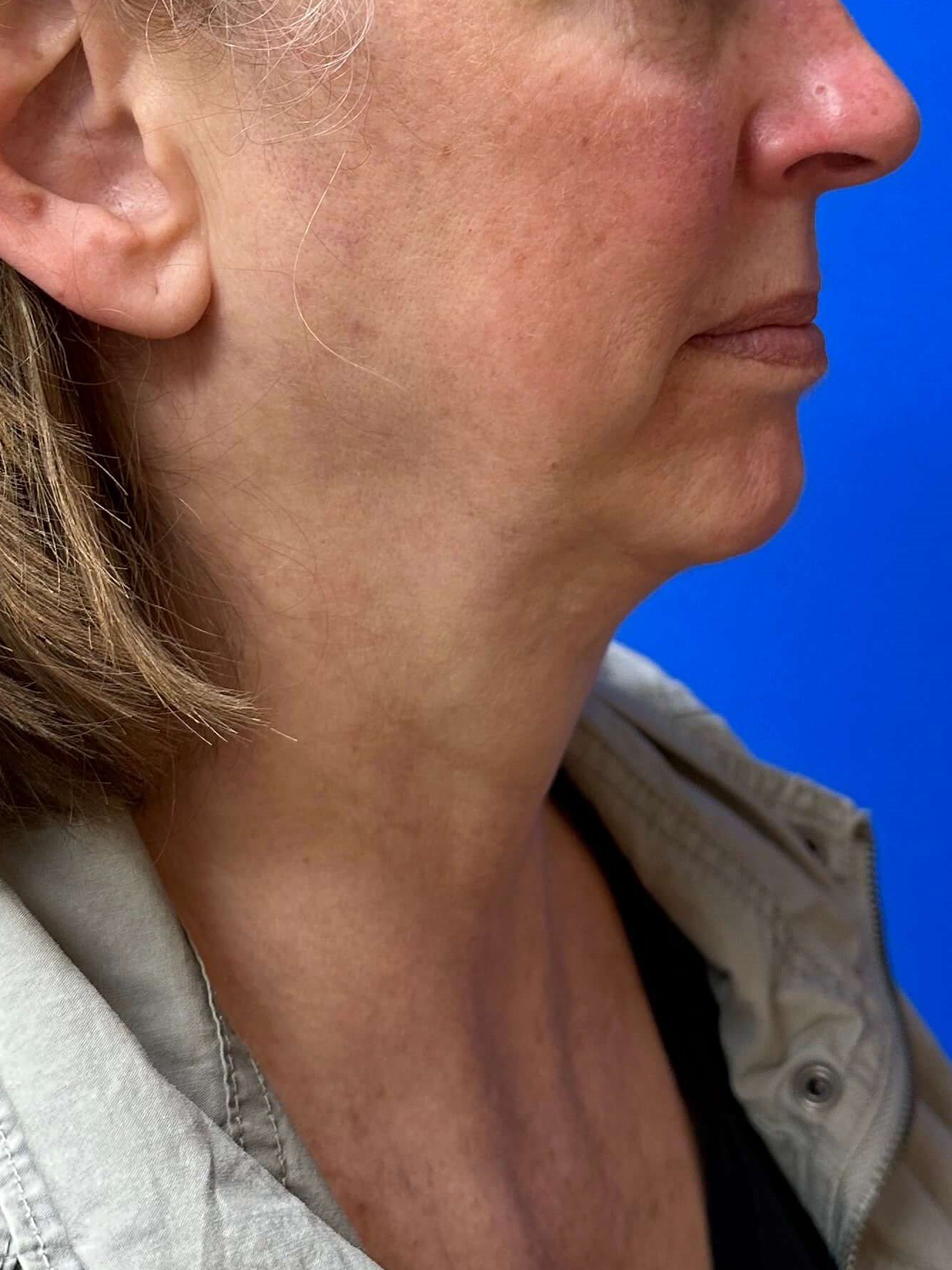 Before Image: Dermal Fillers - right-side