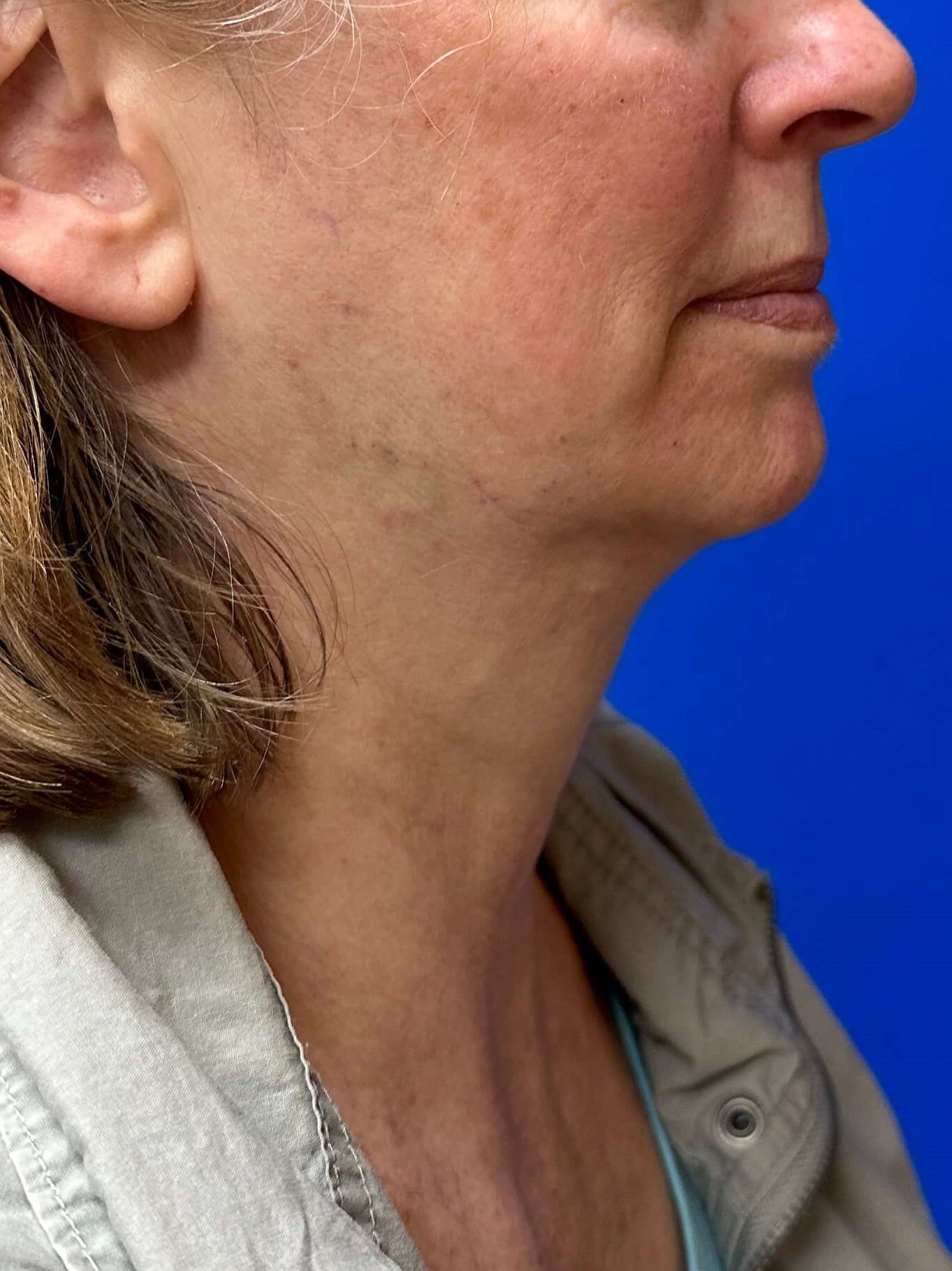 After Image: Dermal Fillers - right-side
