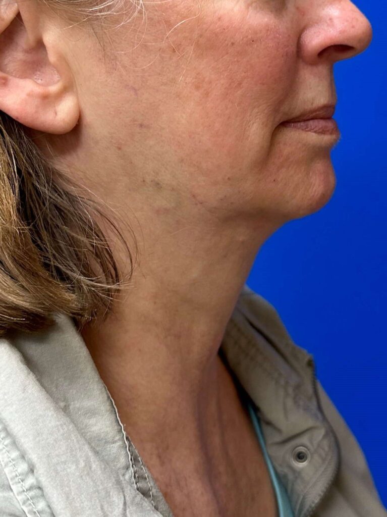 After Image: JUVÉDERM® Volux™ XC - right-side