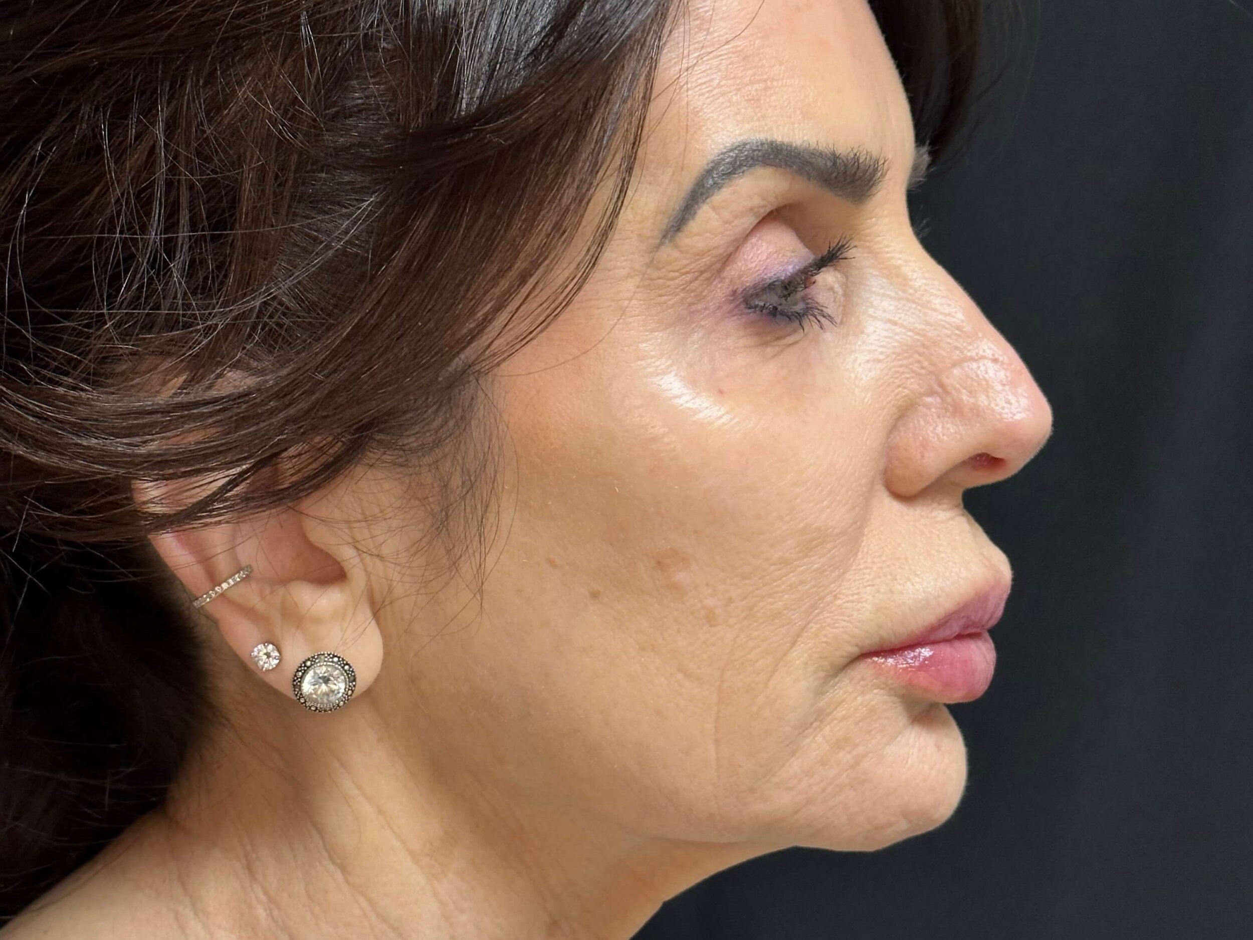 Before Image: Dermal Fillers - right-side