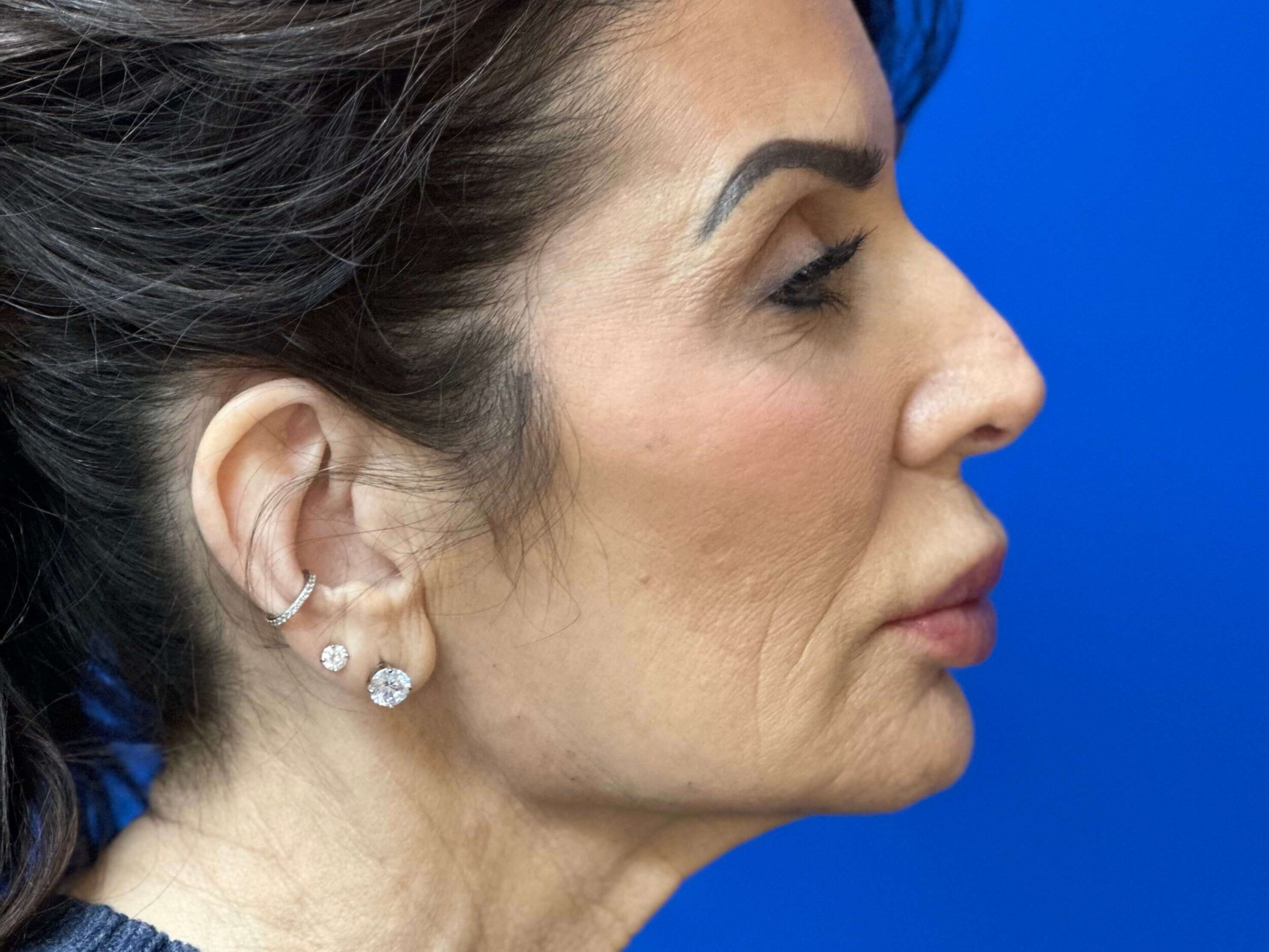 After Image: Dermal Fillers - right-side