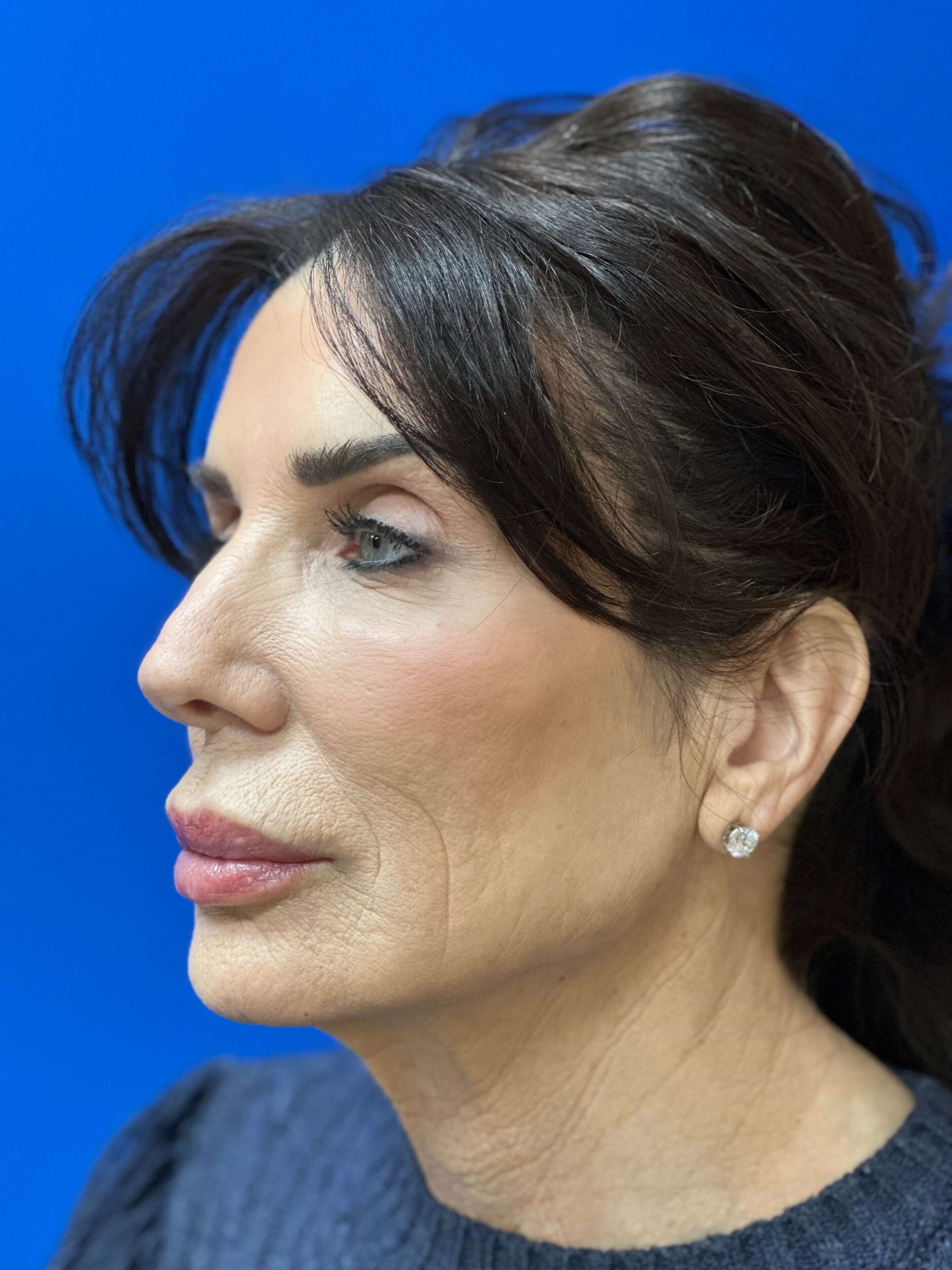 After Image: Dermal Fillers - left-front-oblique
