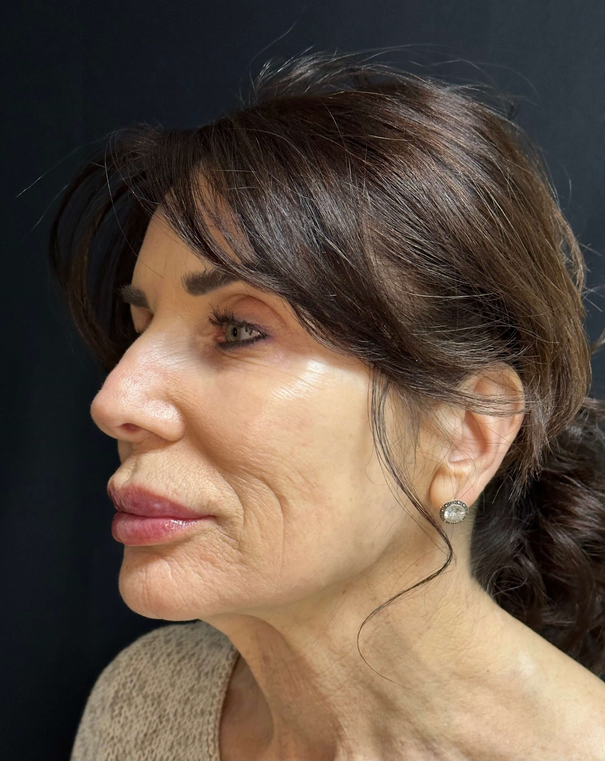 Before Image: Dermal Fillers - left-front-oblique