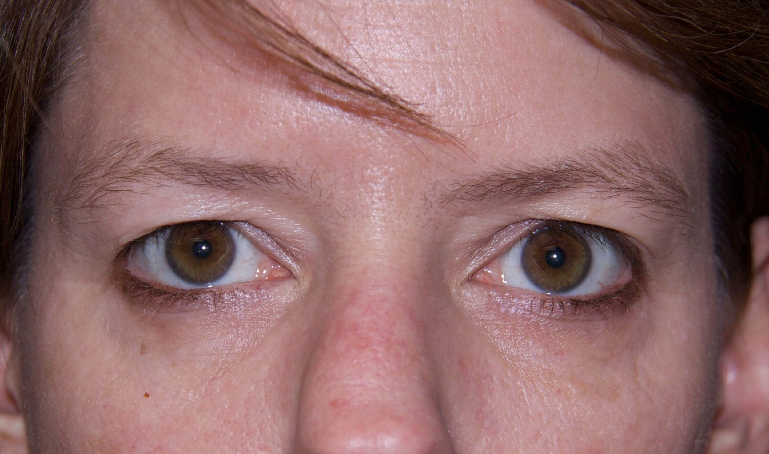 Before Image: Droopy Eyelid Treatment - front