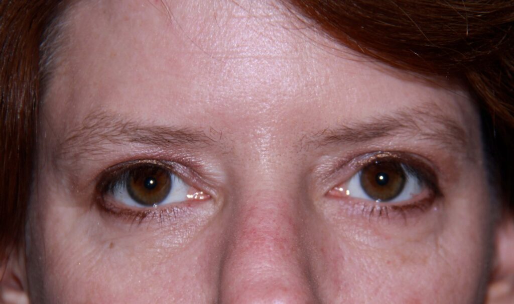 After Image: Droopy Eyelid Treatment - front
