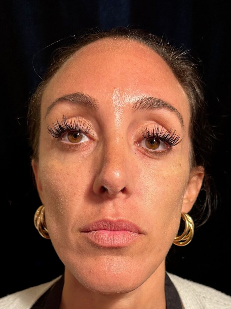 Before Image: Restylane® - front