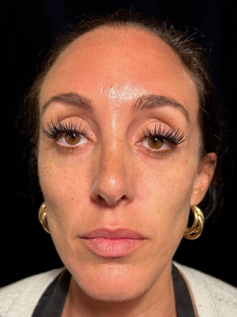 After Image: Restylane® - front