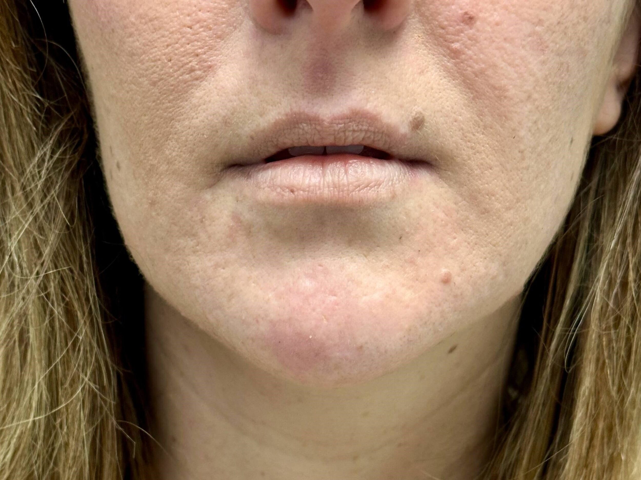 Before Image: Dermal Fillers - front