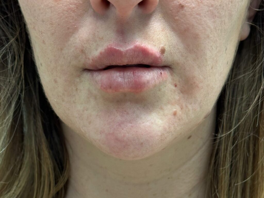 After Image: Dermal Fillers - front