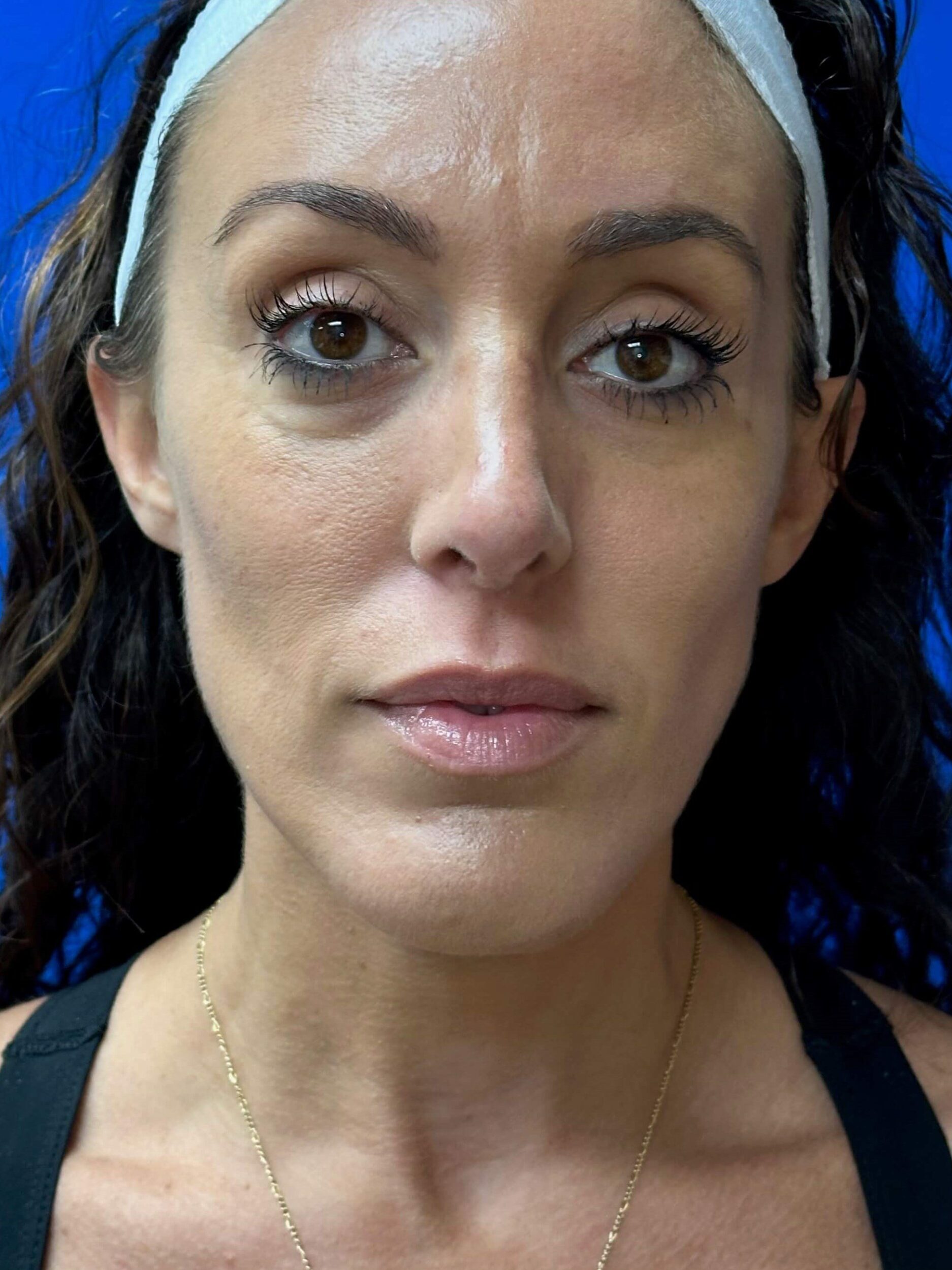 Before Image: Dermal Fillers - front